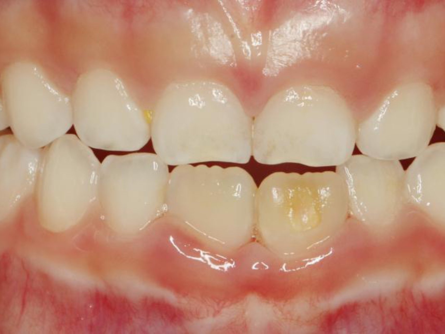 常规复查,妈妈主诉新长的恒牙黄黄的,经医生检查发现是牙釉质发育不全