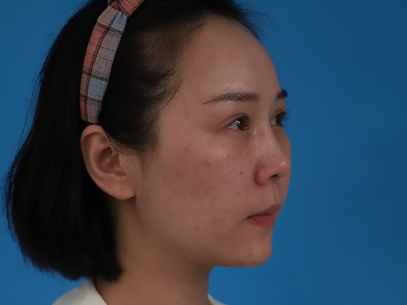 下巴短小后缩韩式生科假体隆下巴_圈子-新氧美容整形