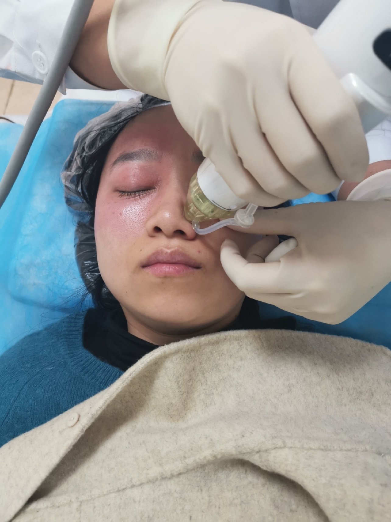 锵锵锵,做完黄金射频微针已经一个多月啦.