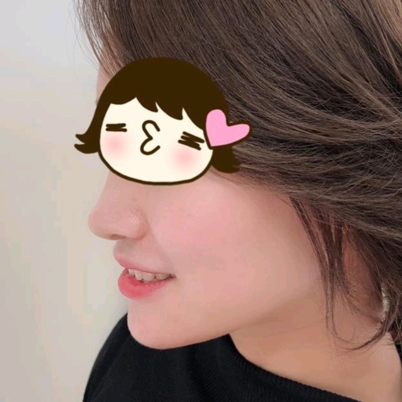 做完线雕鼻已经一个月了,现在已经是恢复好了的一个状态,看着真的是很