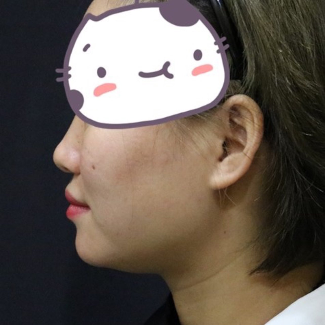 做完线雕鼻已经一个月了,现在已经是恢复好了的一个状_圈子-新氧美容