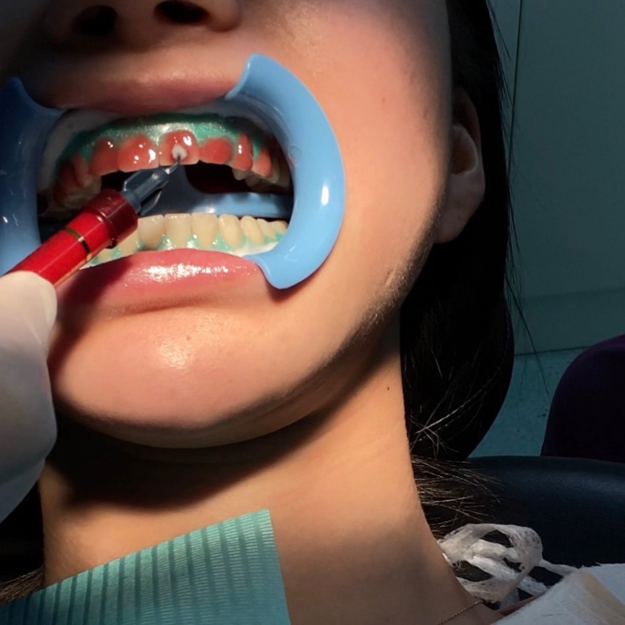 一直觉得自己的牙齿黄,于是种草了皓齿美白