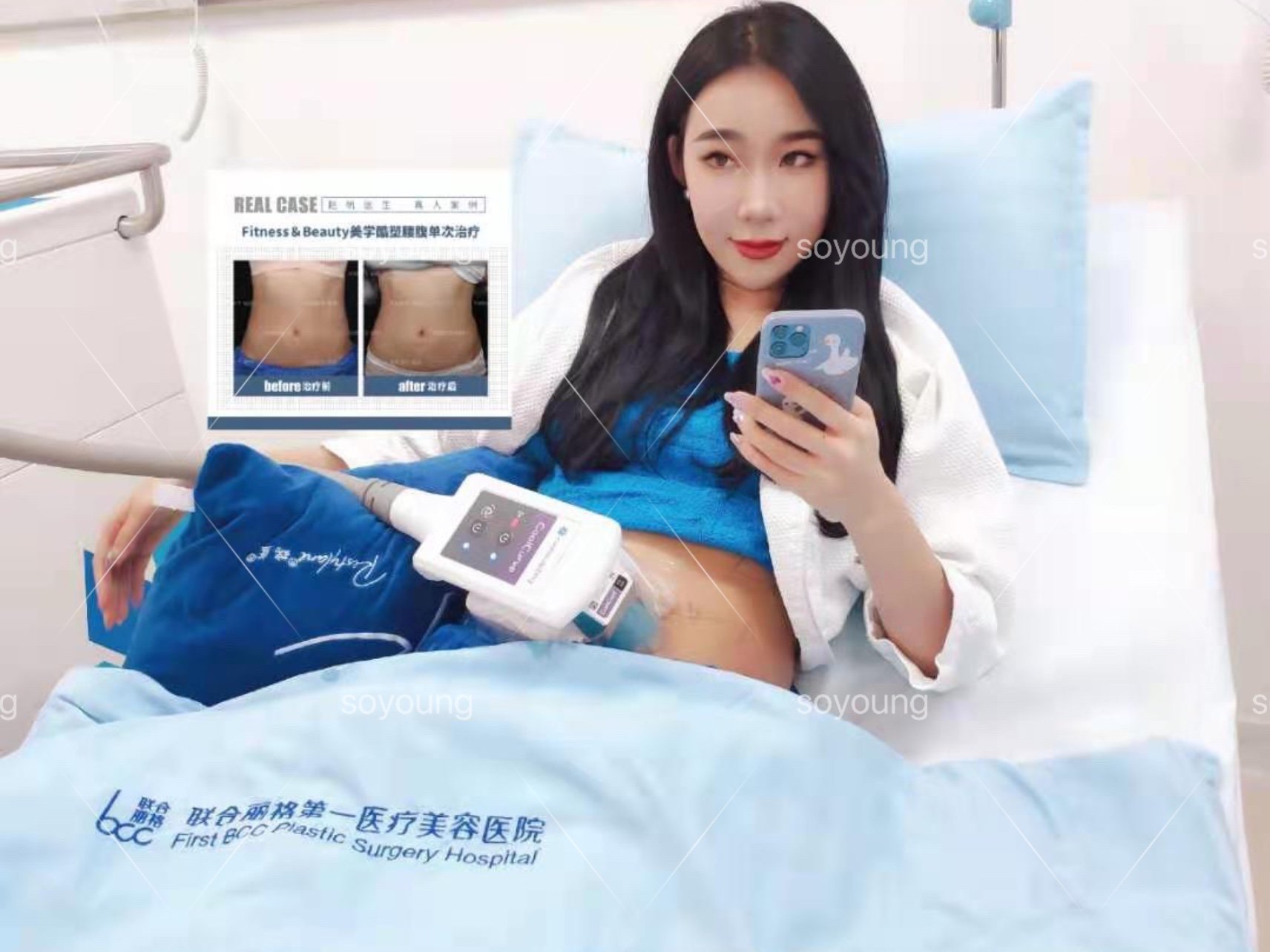 分享一下我的酷塑治疗治疗前腰腹部有赘肉,鼓鼓的,肉_圈子-新氧美容