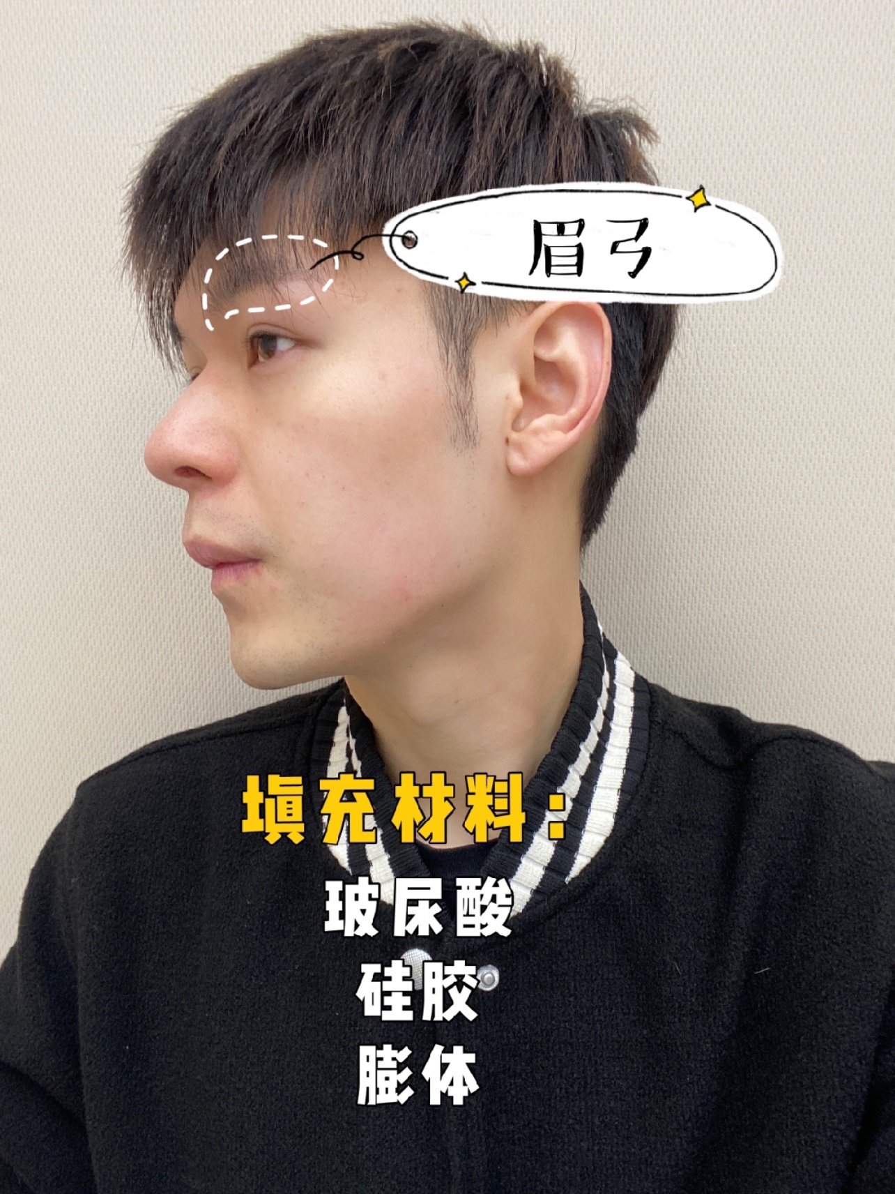 玻尿酸填眉弓会不会掉下来