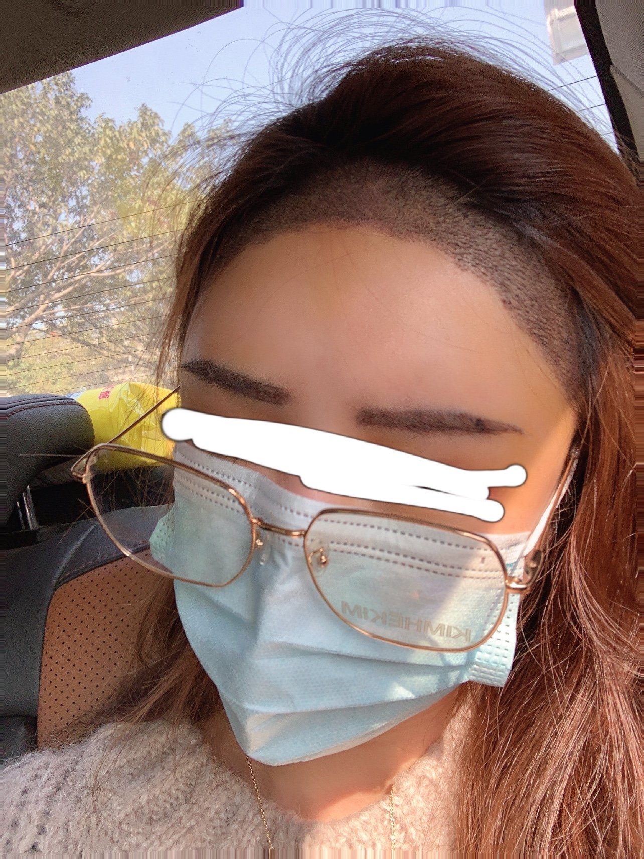 植发术后第四天功课迟发了sry!照片是第4天拍的,_圈子-新氧美容整形