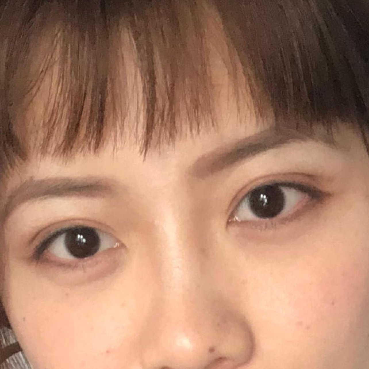 元旦假期做了双眼皮我做的是7厘米的小扇型全切双眼皮_圈子-新氧美容