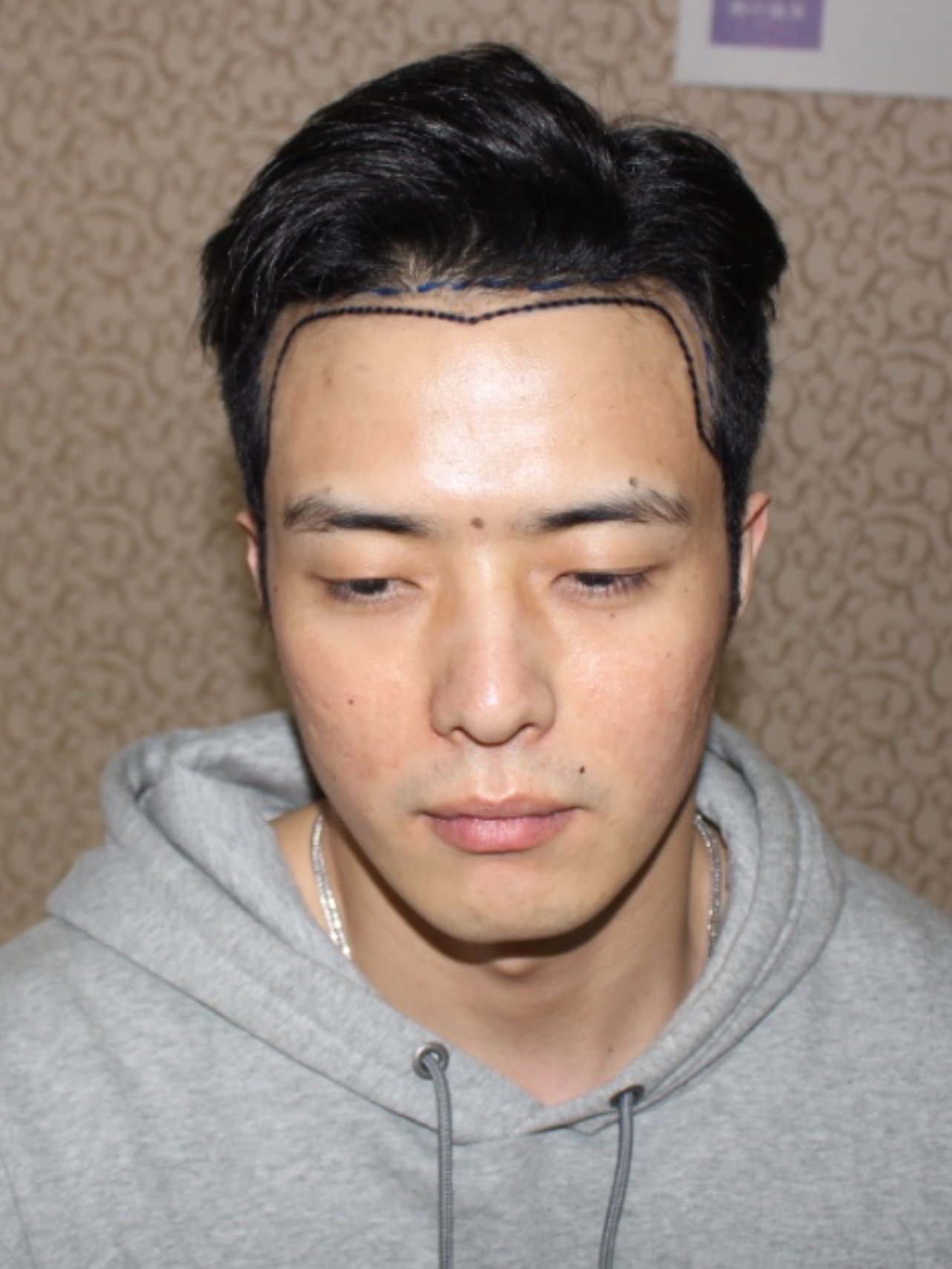 大麦微针植发·术前9797发友情况:男生的脱发主要也是_圈子-新氧