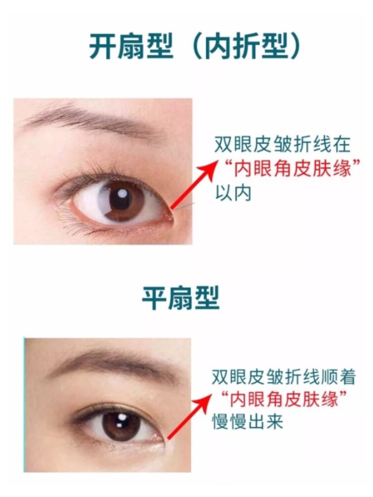 都说割双眼皮后颜值会提升很多,有的效果甚至堪比换头,但实际上有人割