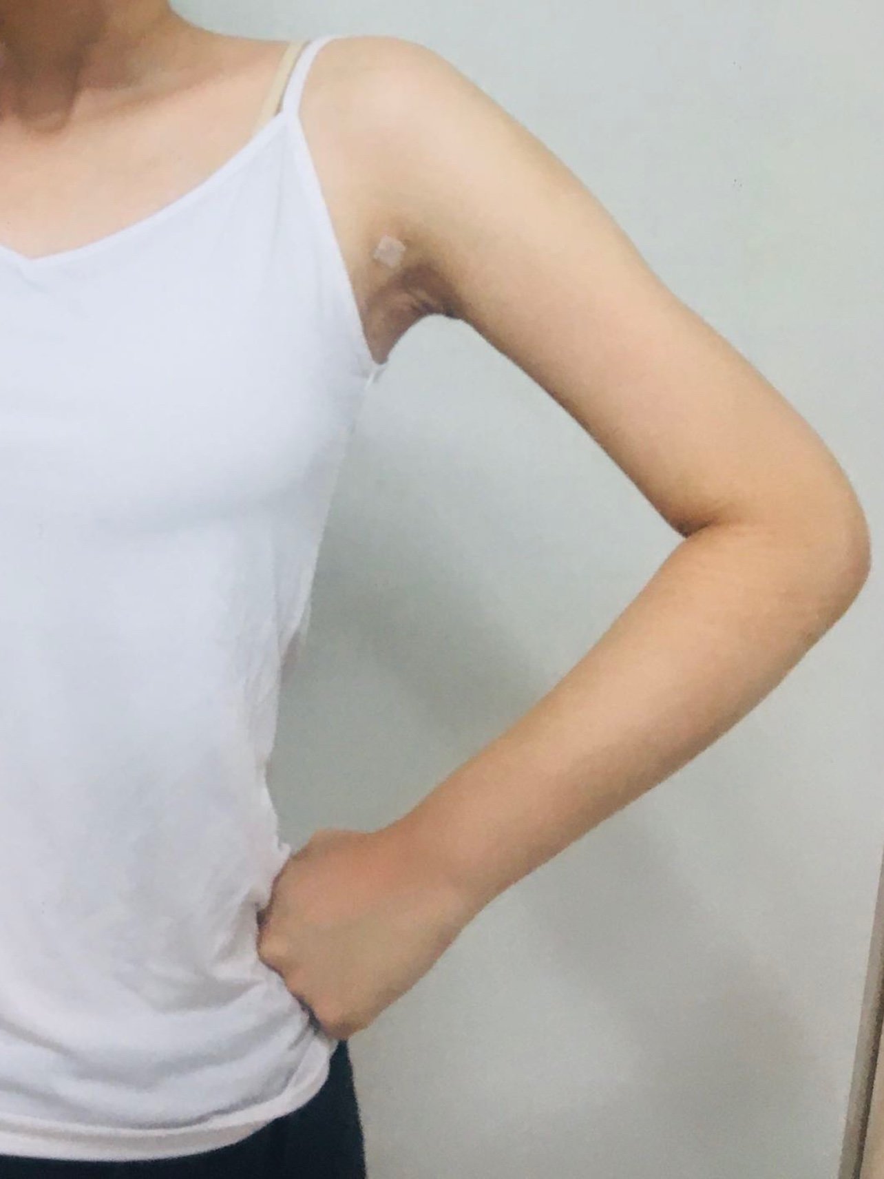 韩国wiz美 手臂迷你吸脂 15天