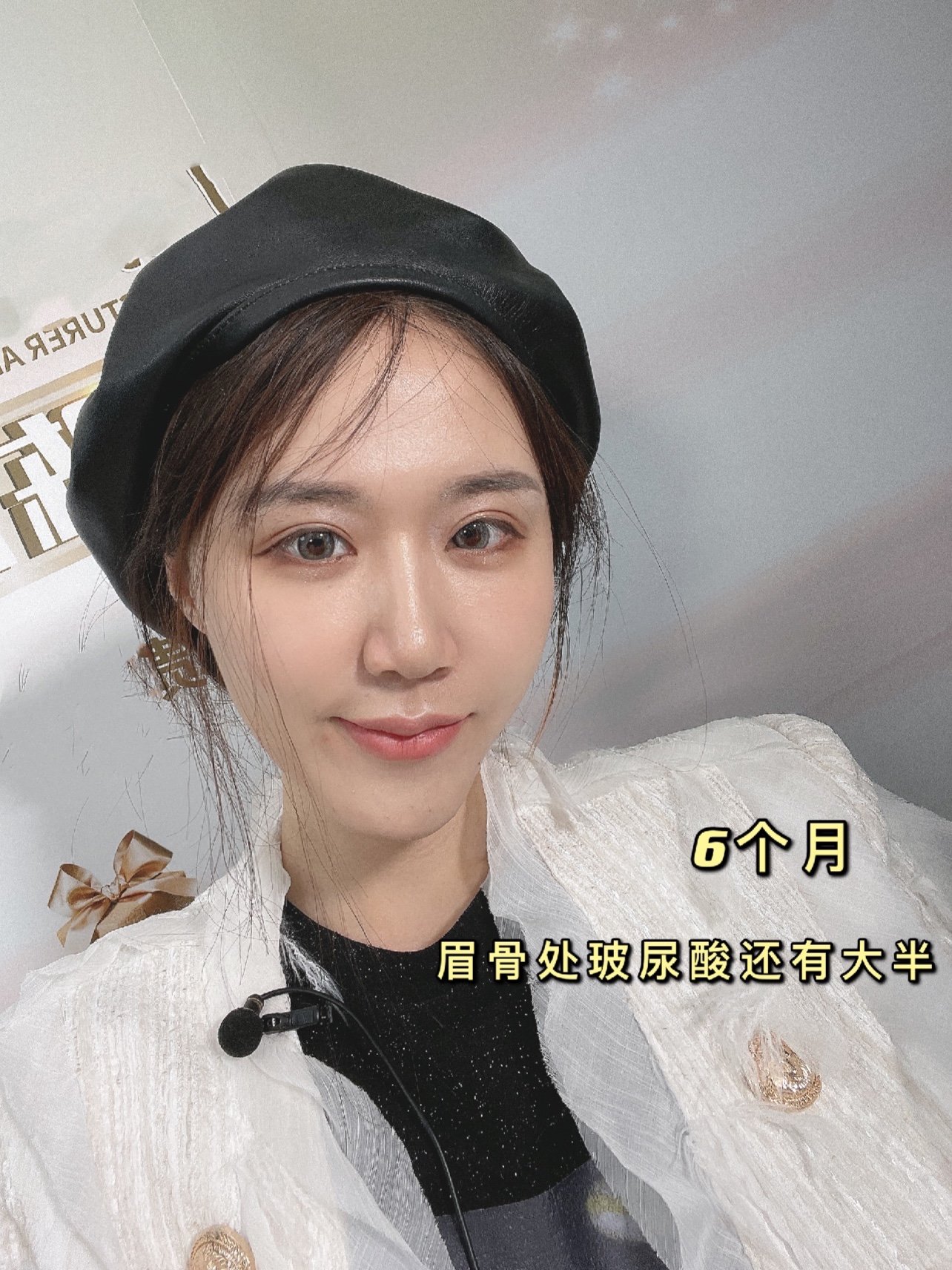 作为一个眉骨低平,可以说完全没有眉骨的人,总感觉上_圈子-新氧美容