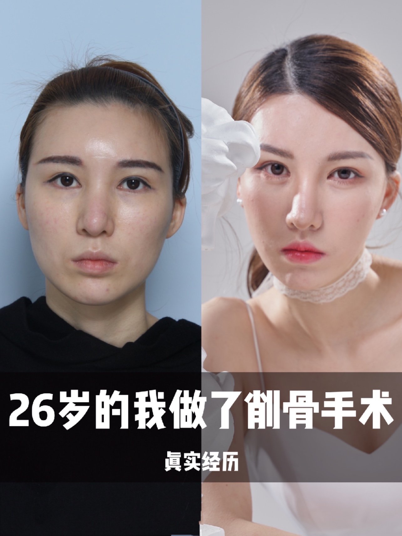 26岁削骨我后悔了吗?