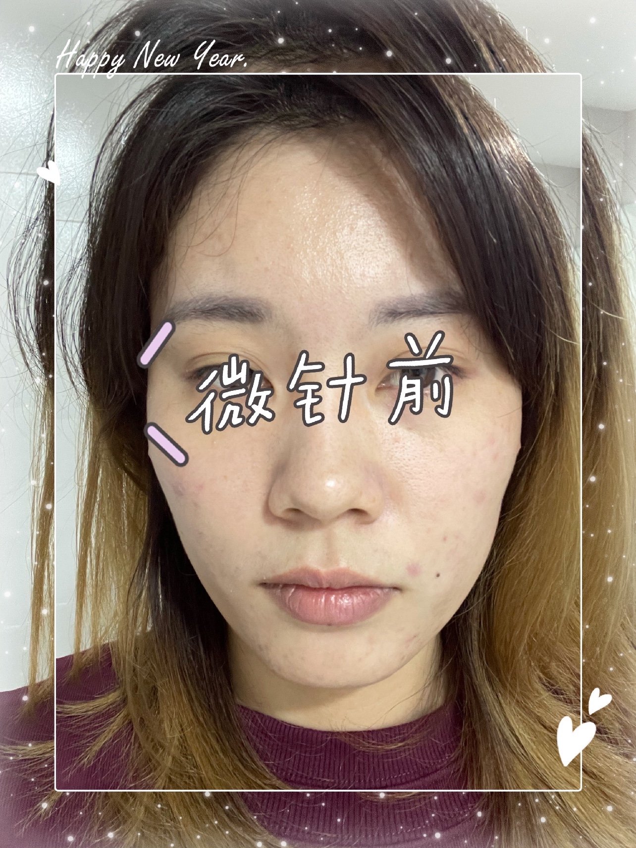 可丽金星光胶原蛋白微针