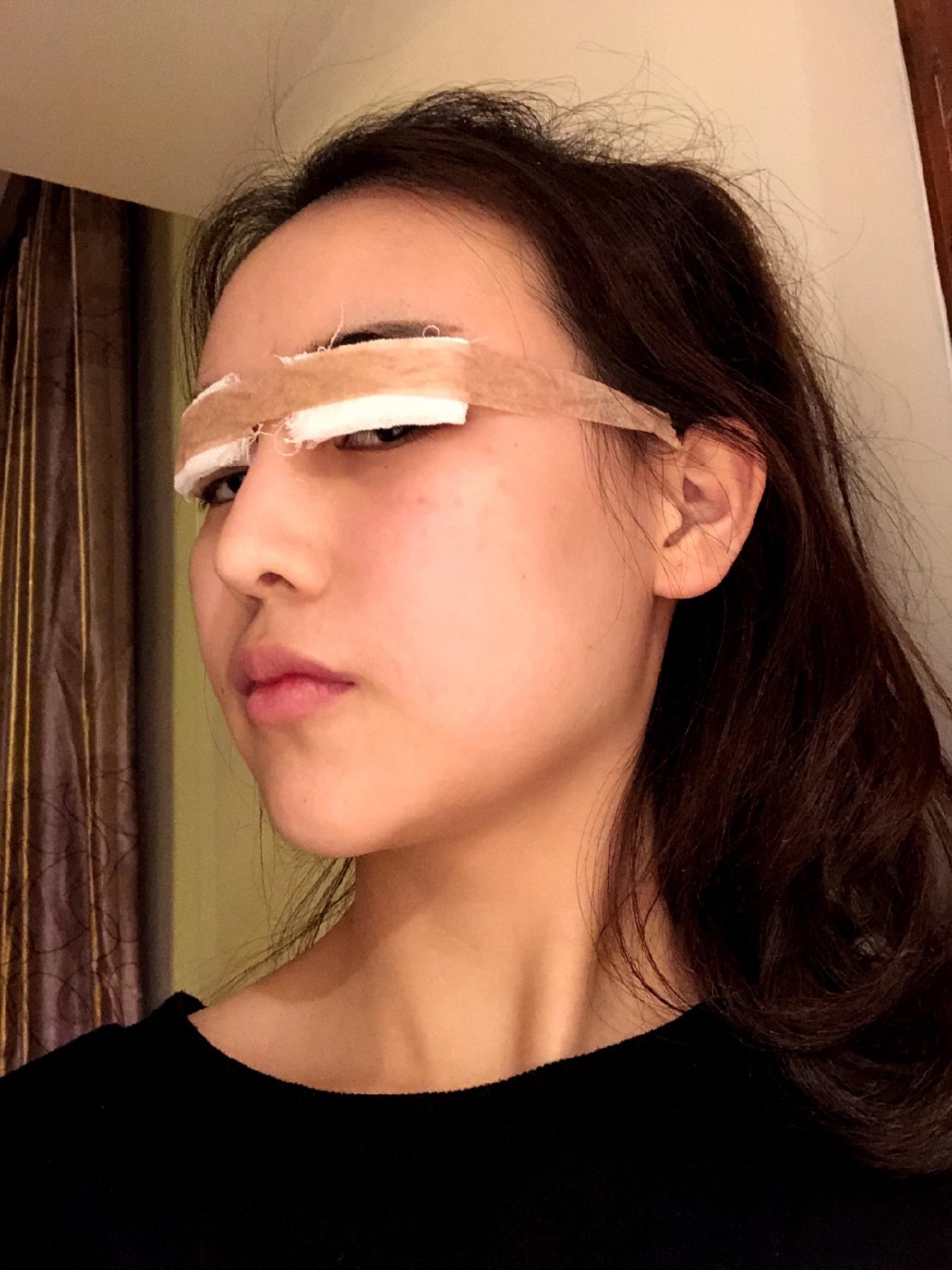 切完双眼皮了记录一下,这个纱布贴在眼睛上面挡视线现_圈子-新氧美容