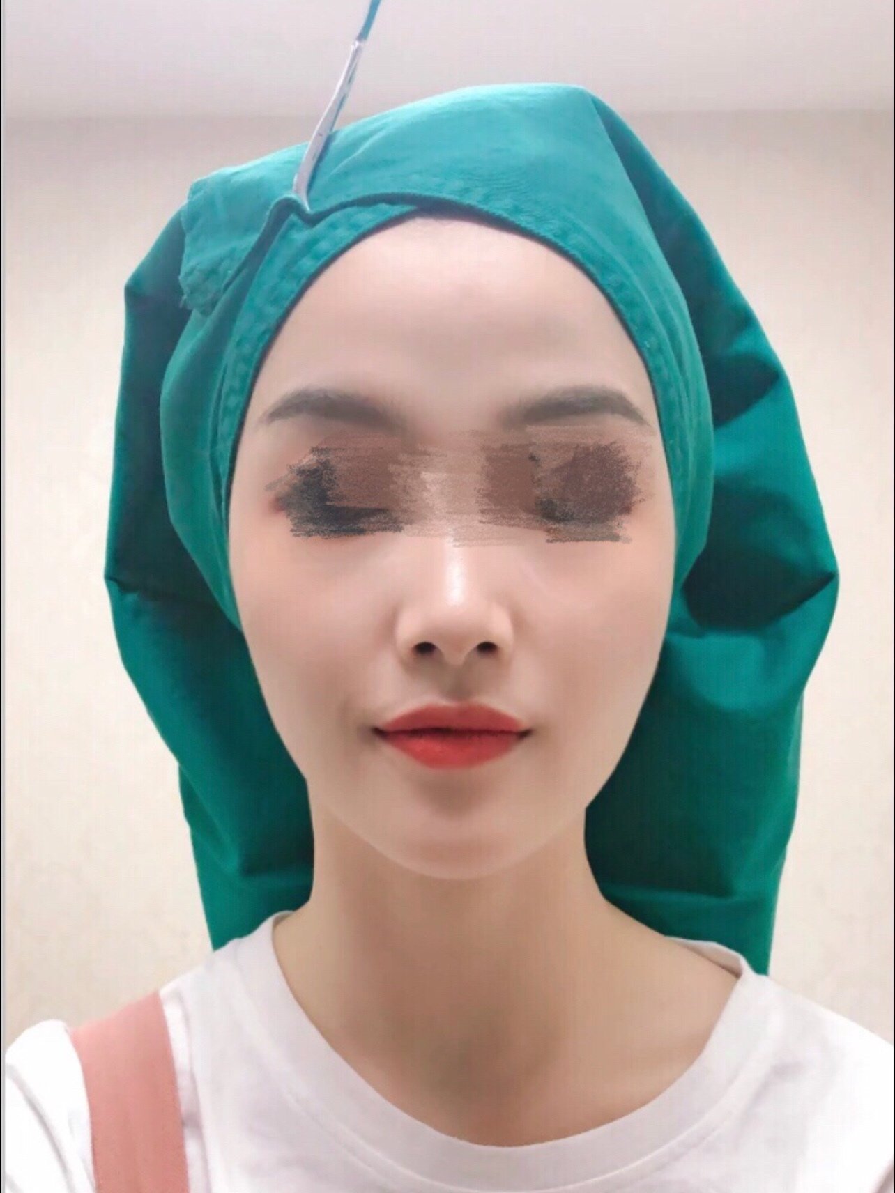 做了耳后小切口拉皮术,第三天第四天基本消肿了医生说_圈子-新氧美容