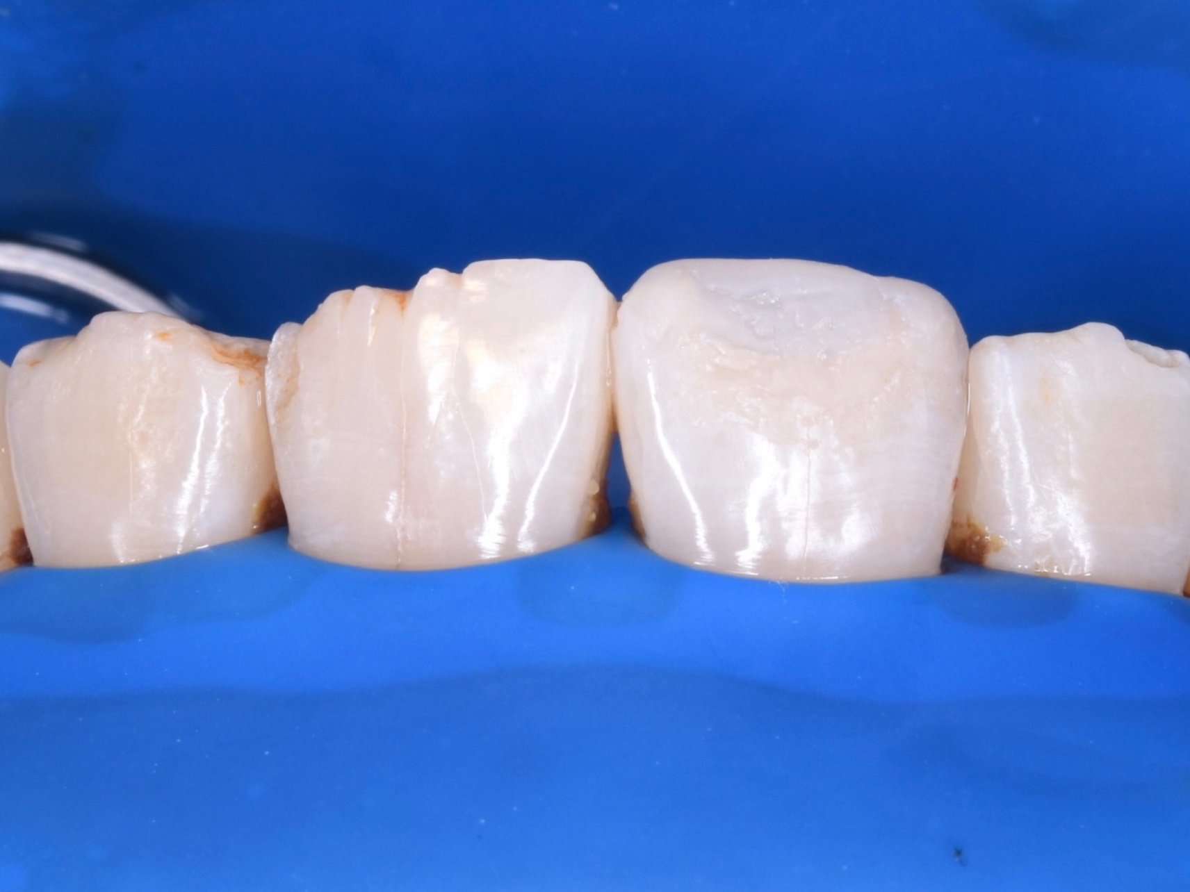 门牙美学修复树脂补牙一例前牙单颗树脂充填,有点遗憾