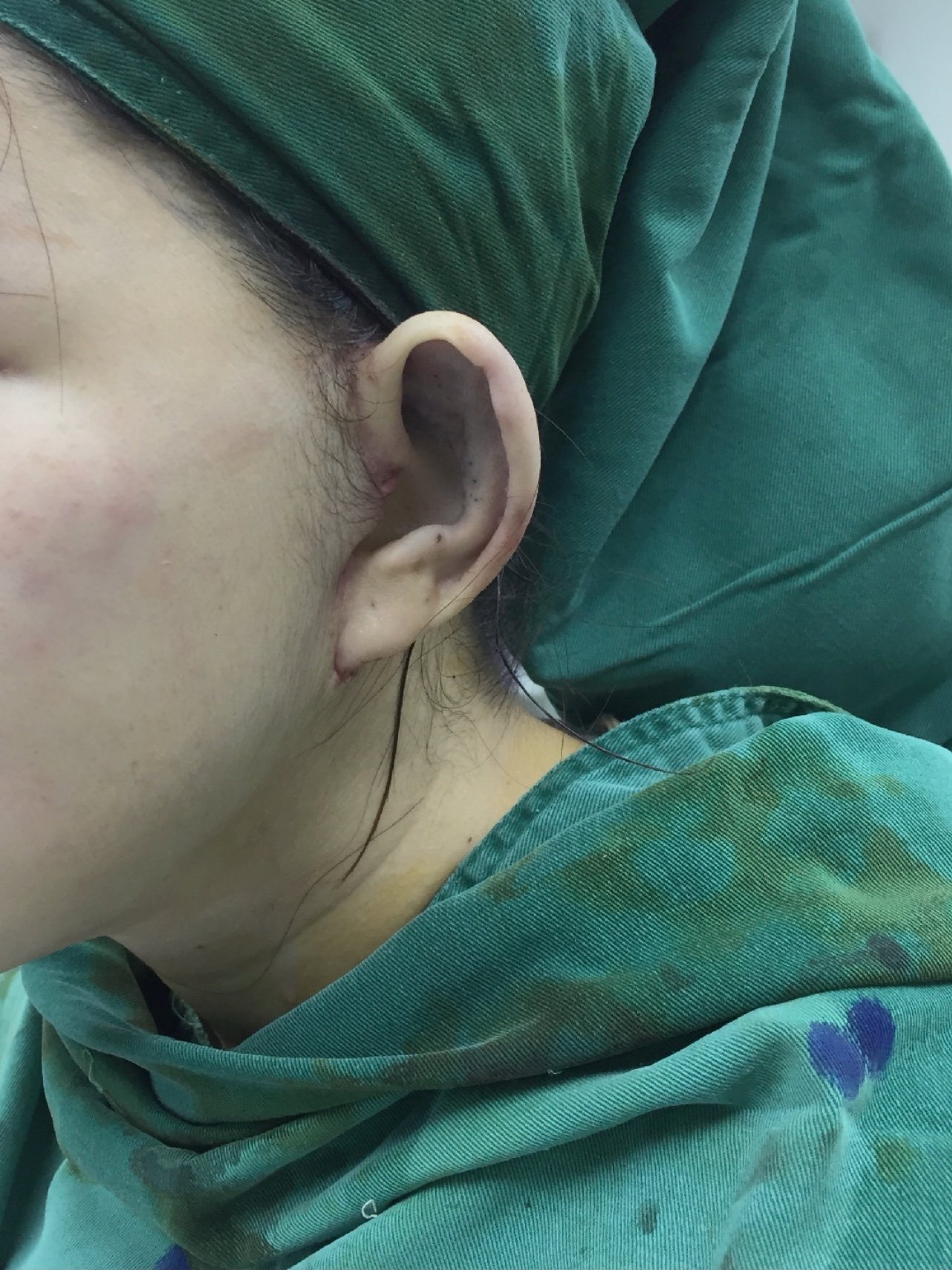 一小时变小脸贴发耳手术矫正