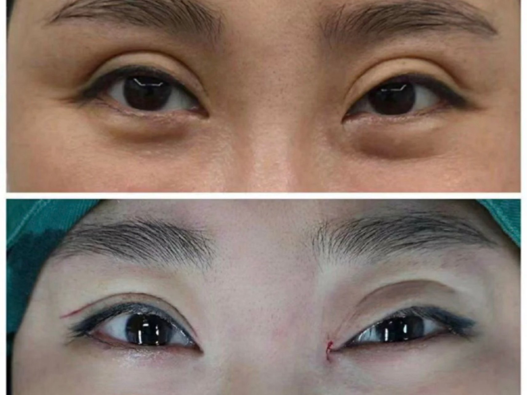 前眼睛做的不好,一个是过宽,还有就是上睑下垂,眼_圈子-新氧美容整形
