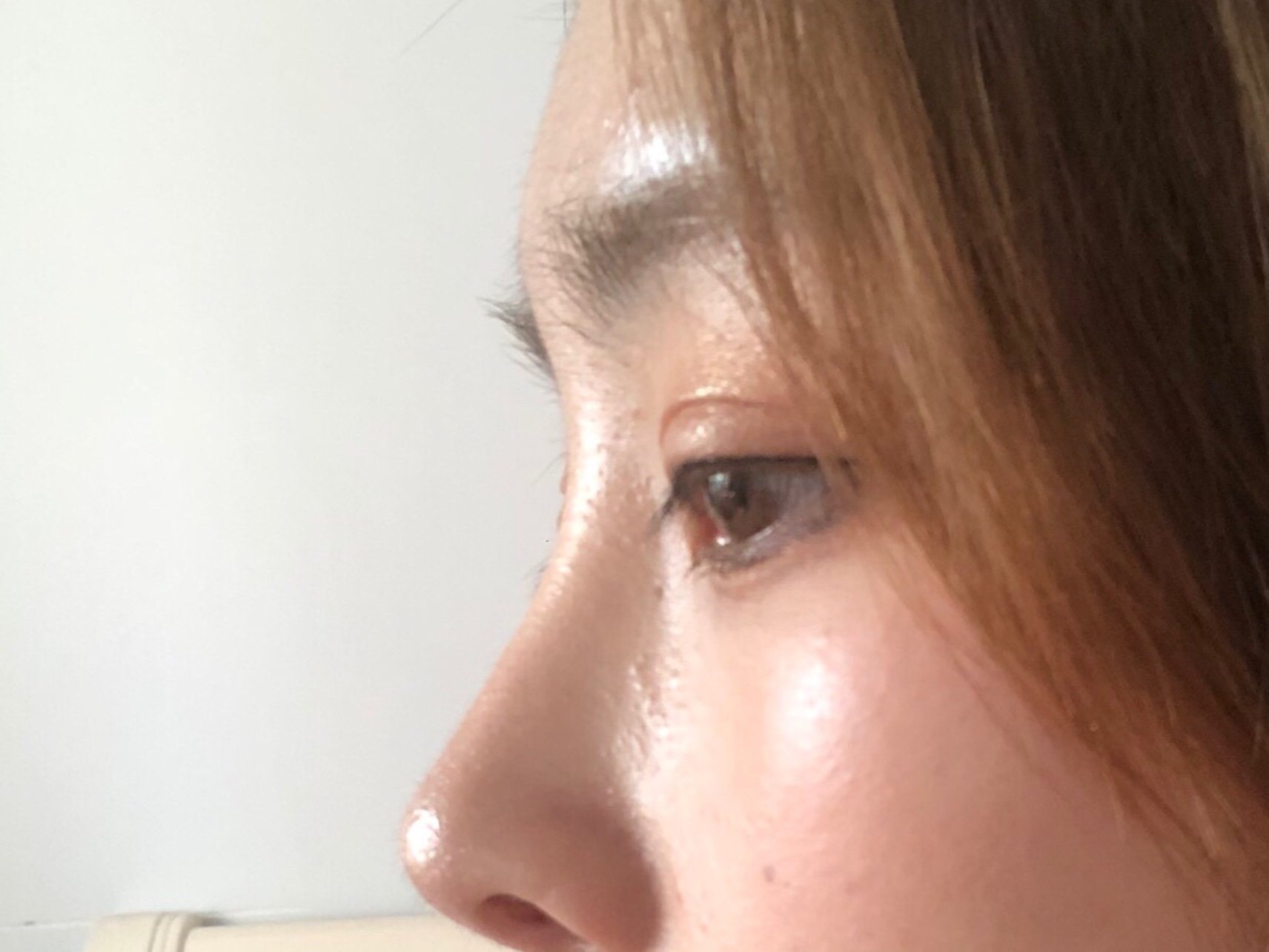 鼻部多项术后近10个月效果返图,局部返图清晰,供大家_圈子-新氧美容