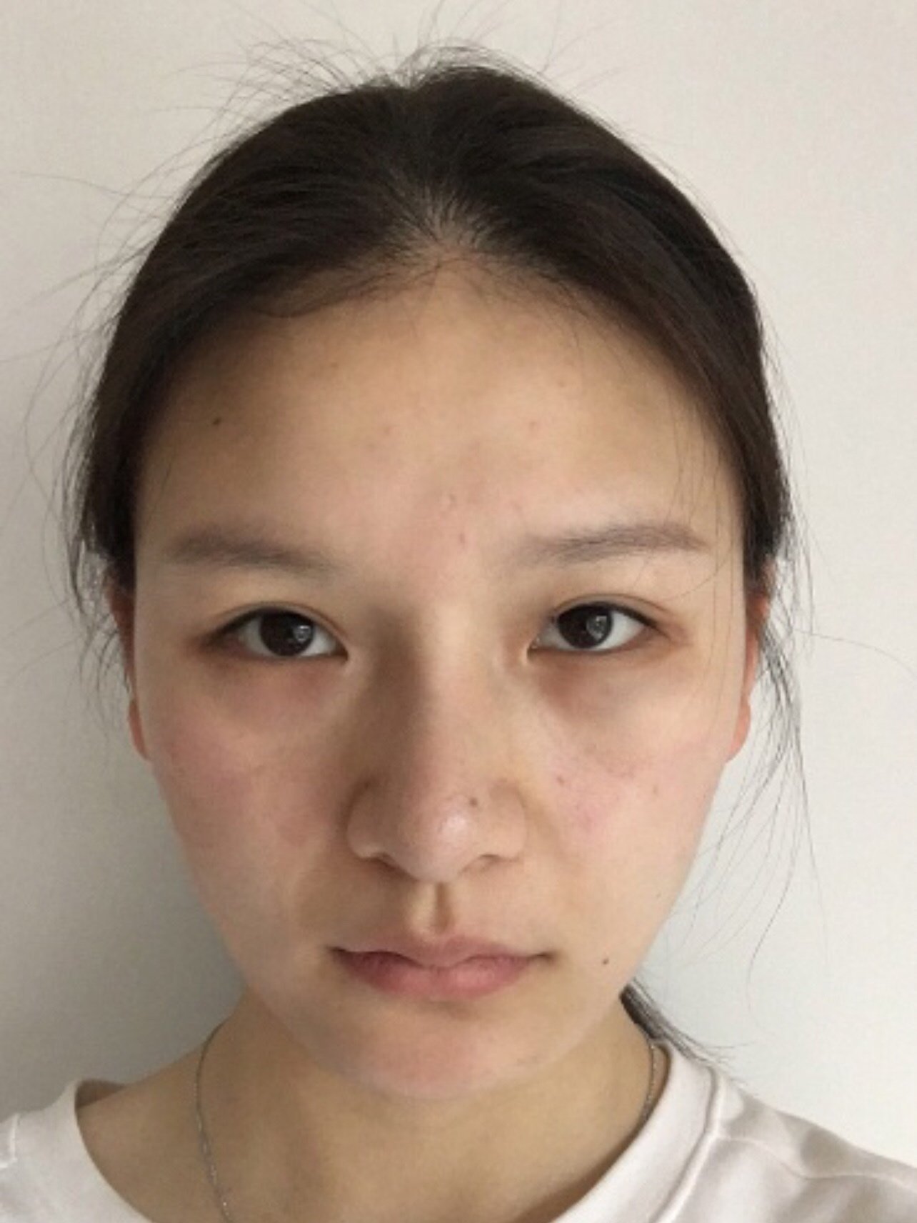 皮肤松弛,苹果肌下移,法令纹逐渐显现,而且下颌缘的_圈子-新氧美容