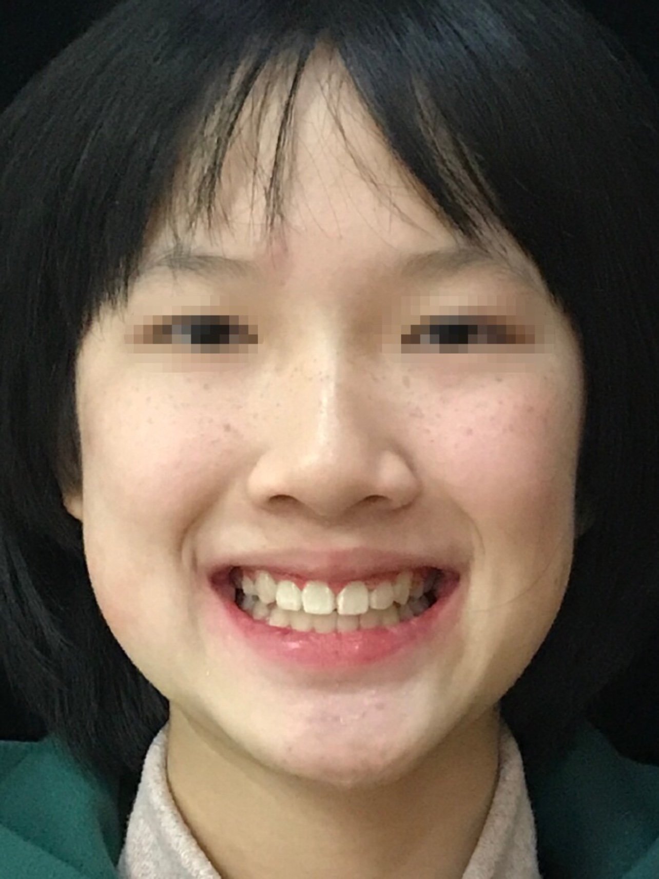 牙齿重度拥挤不齐虎牙外突严重封印了颜值