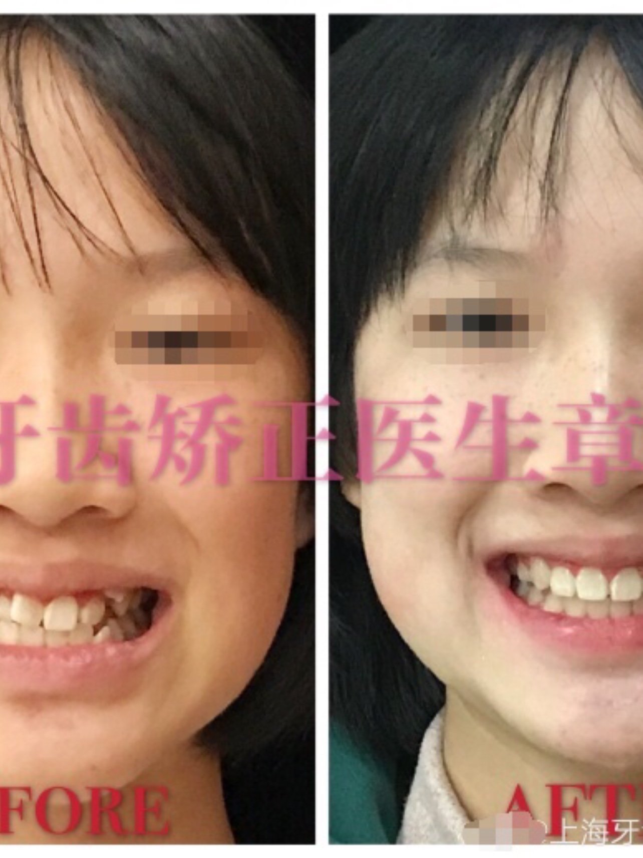 牙齿重度拥挤不齐虎牙外突严重封印了颜值