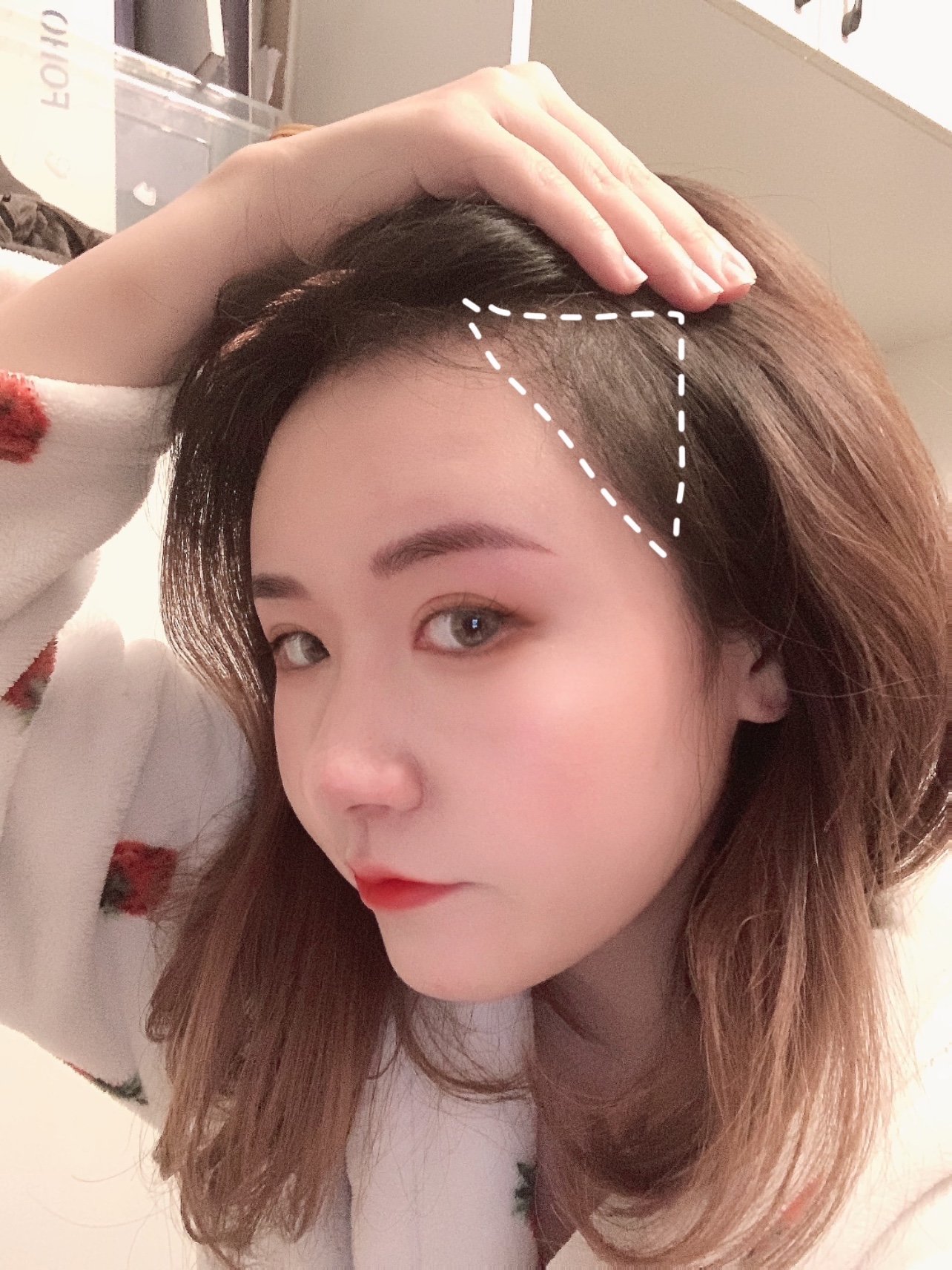 不剃发植发际线功课-术后3个月反馈