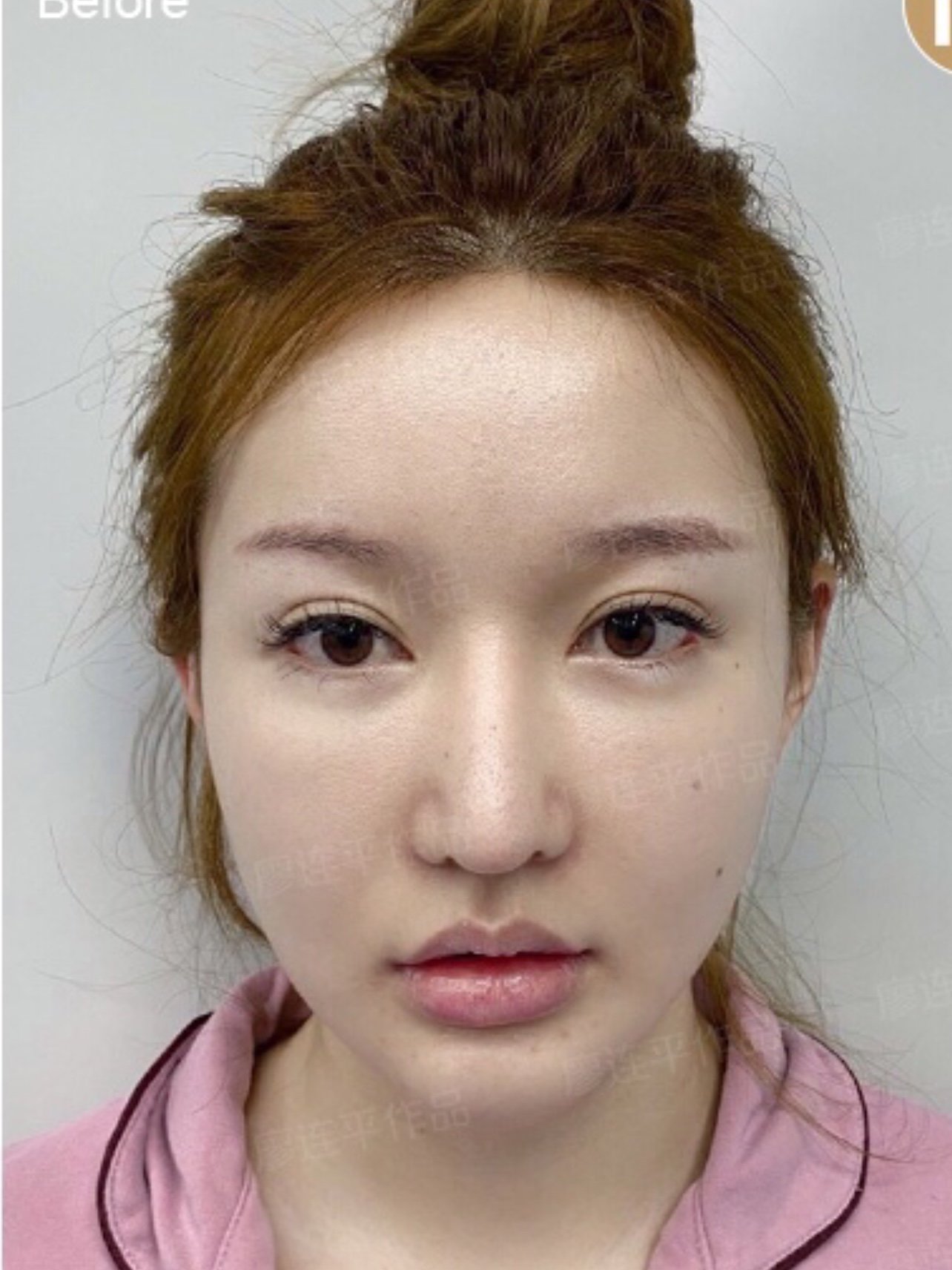 取原肋修复改善鼻子下坠硬朗做甜美系少女