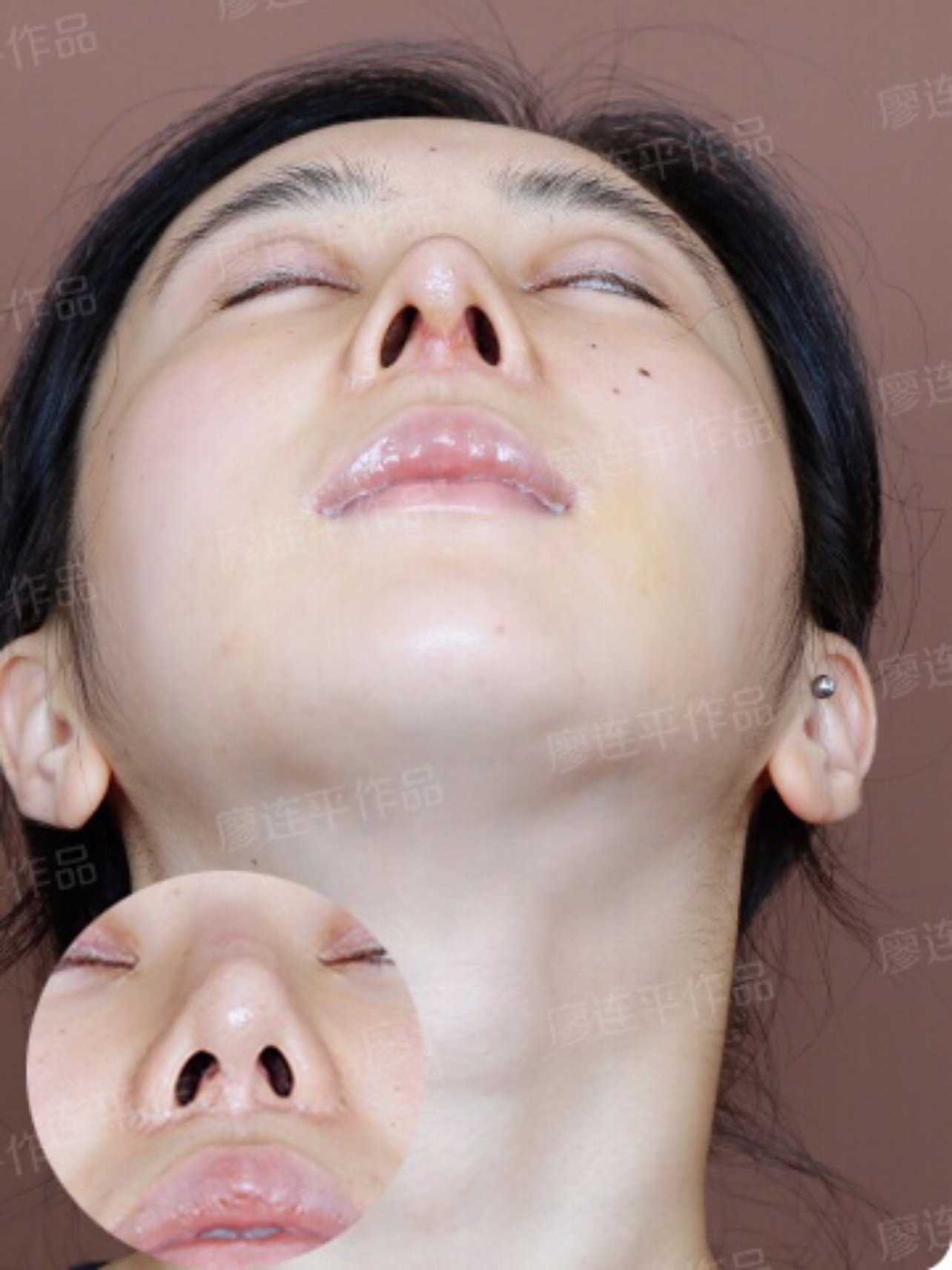 3次鼻修复案例分享