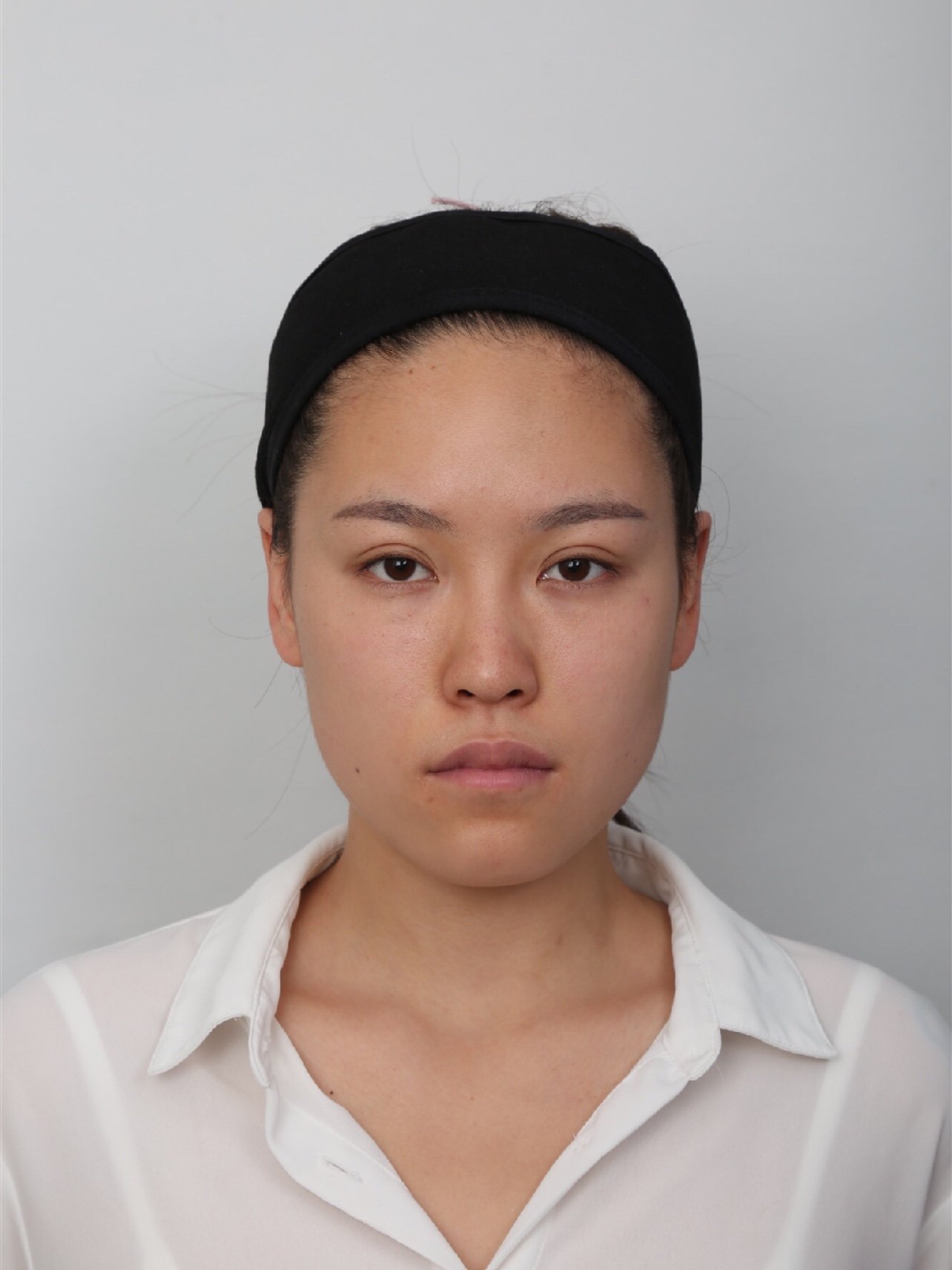 术前问题分析:01较为严重扁平鼻;02鼻梁短,鼻翼_圈子-新氧美容整形