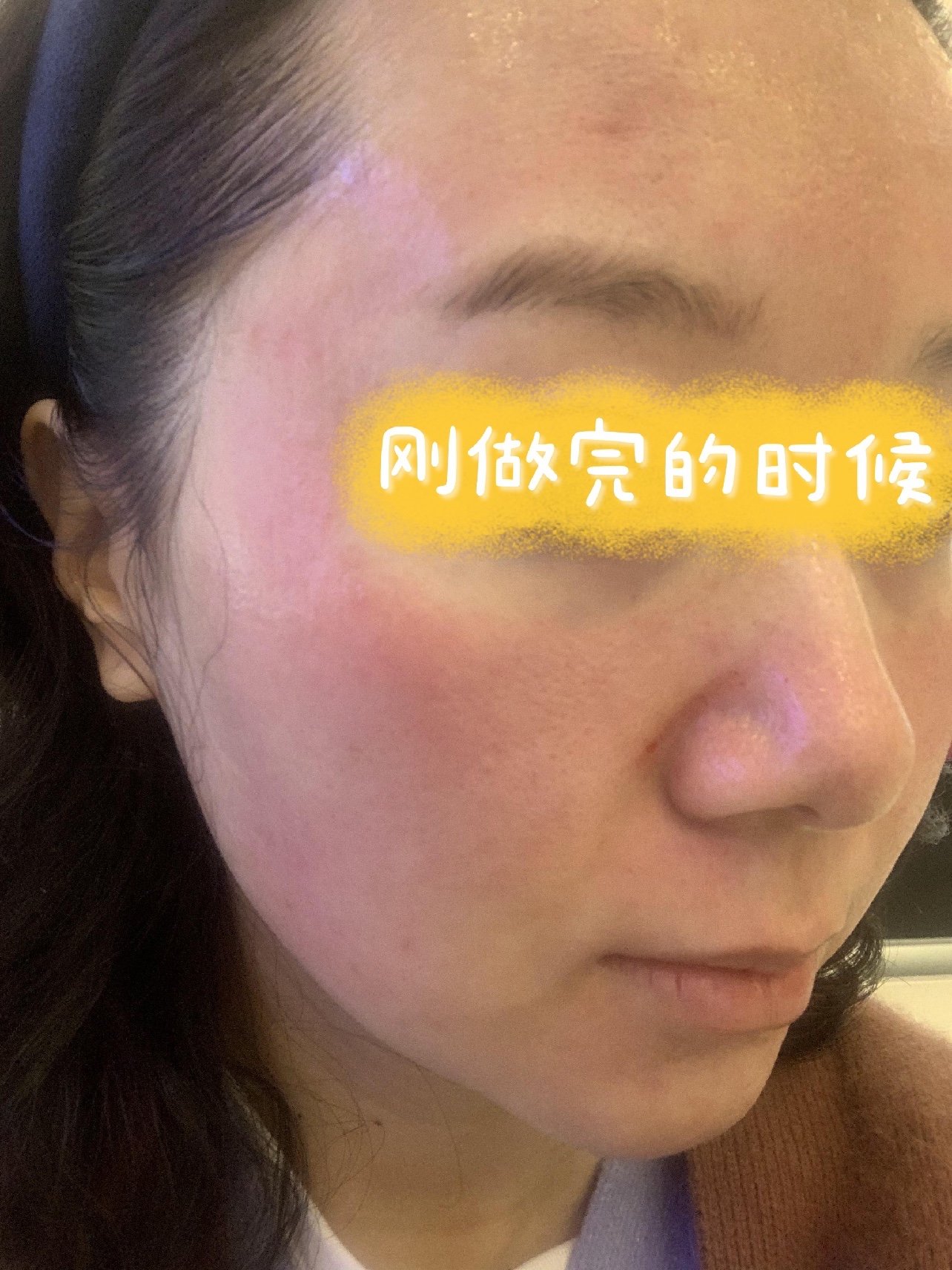 做完可丽金微针经历了丑陋可怕的一周那几天还正好赶