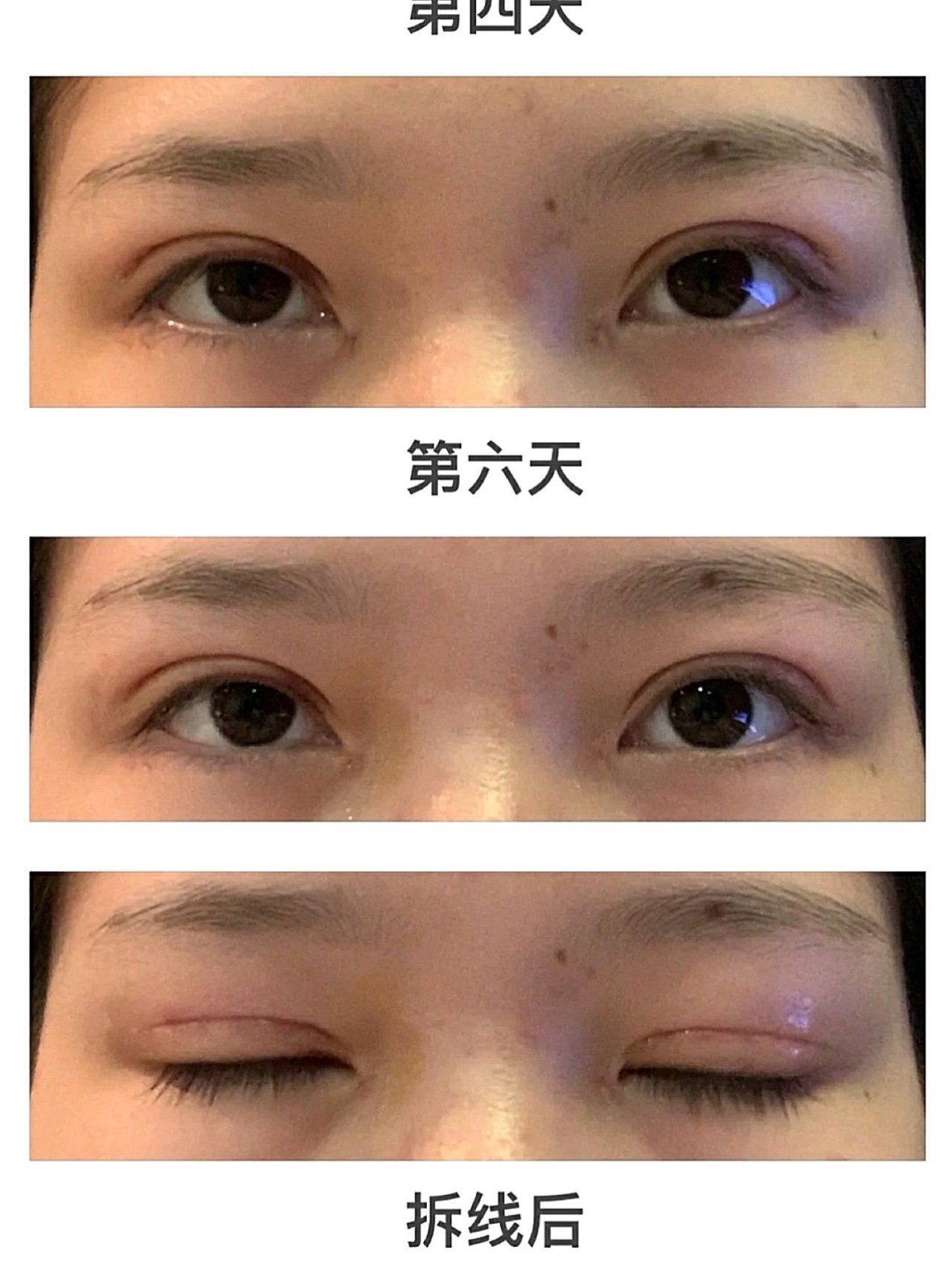 上眼睑脂肪厚重2.上眼睑肌无力双眼皮全切开眼角_圈子-新氧美容整形