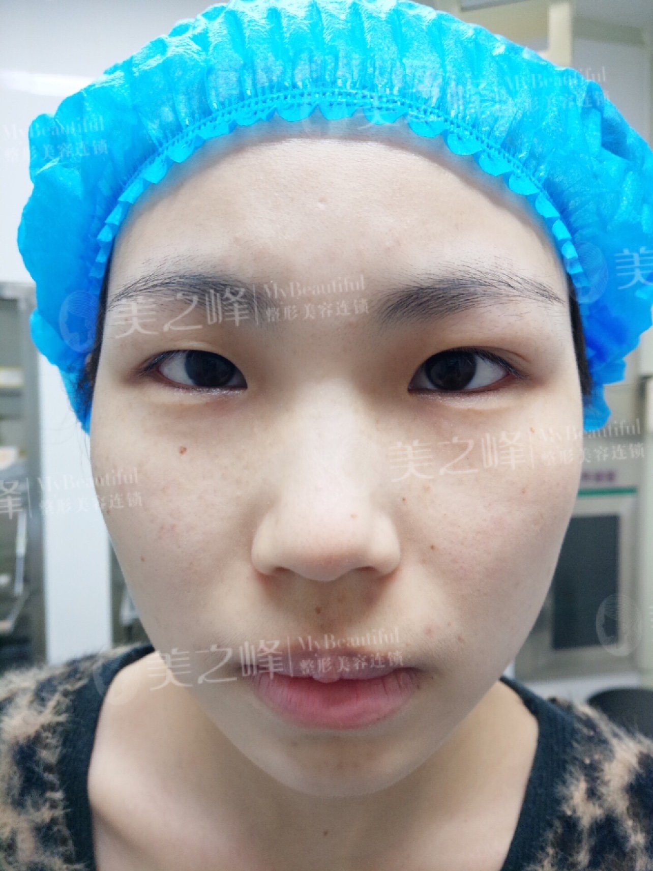 小姑娘术前是小内双,眉骨颧骨较高,眉眼间距近,内眦_圈子-新氧美容