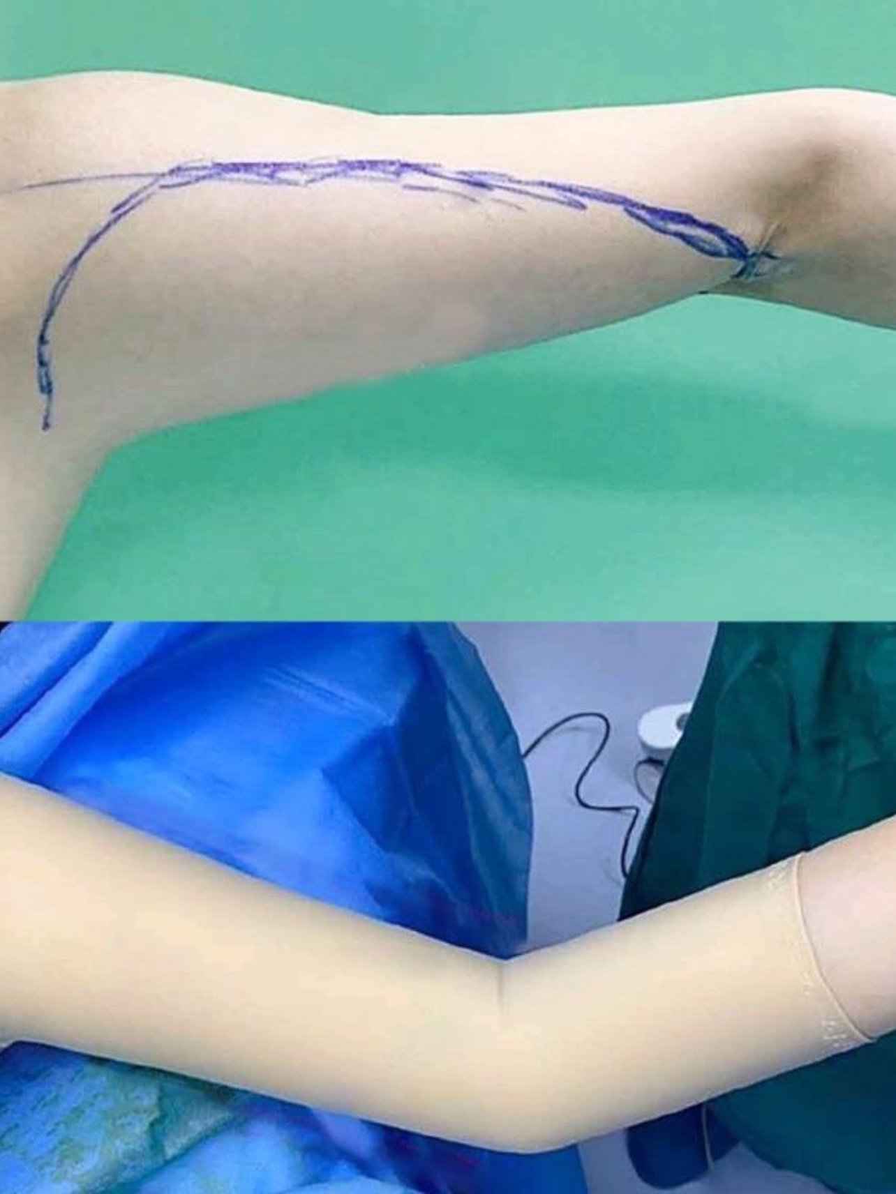 手臂吸脂第一步就是手臂需要吸脂的部位划线