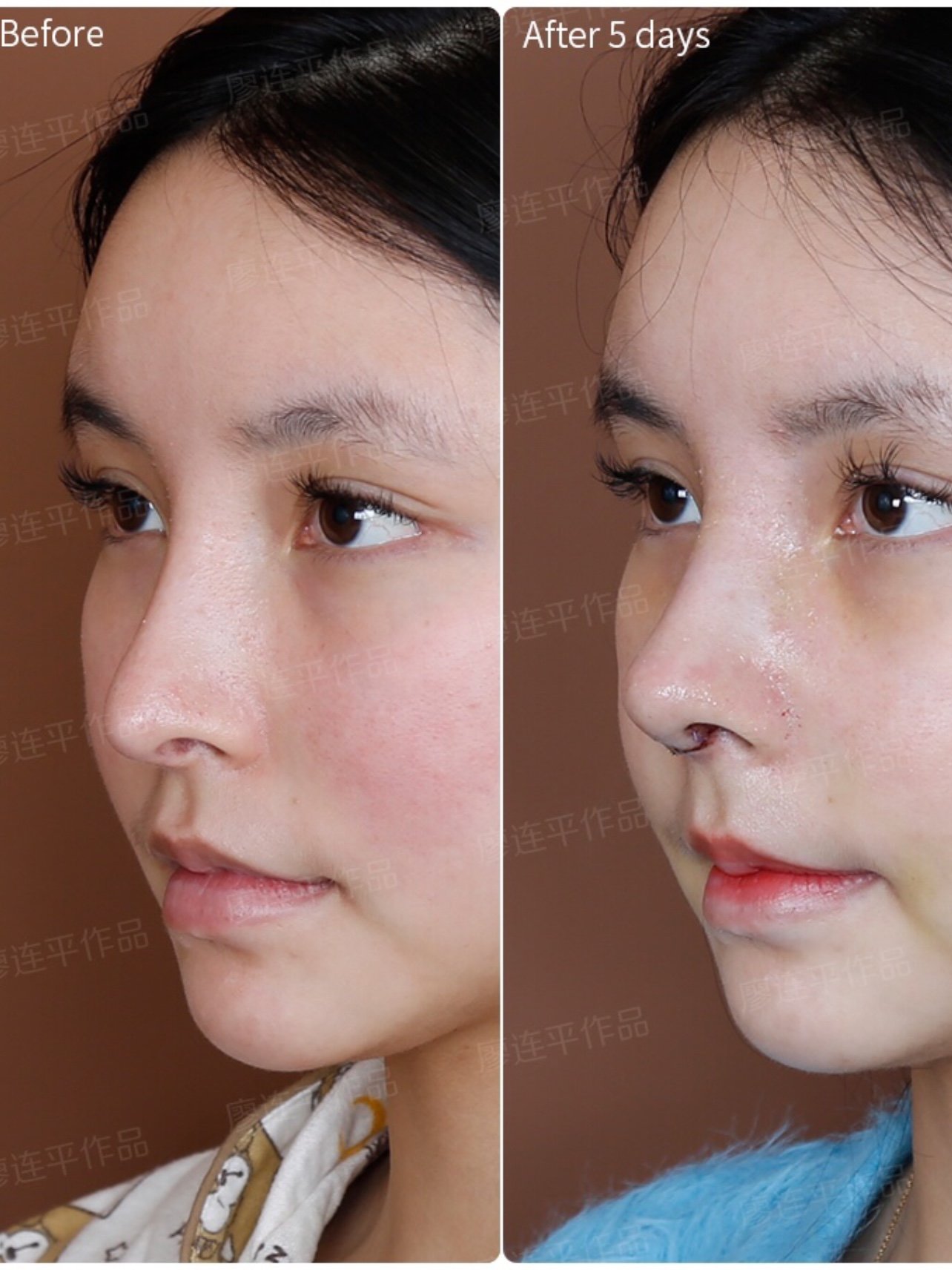 既往手术史:第1次半肋 假体,第2次全肋隆鼻(韩国医生) 术前问题:鼻子