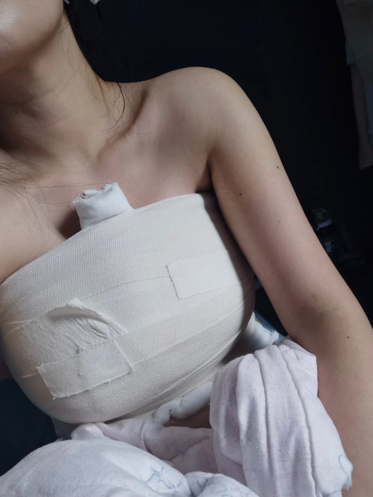 做胸第29天快满月啦,好快,今天锻炼了一下,练了下_圈子-新氧美容整形