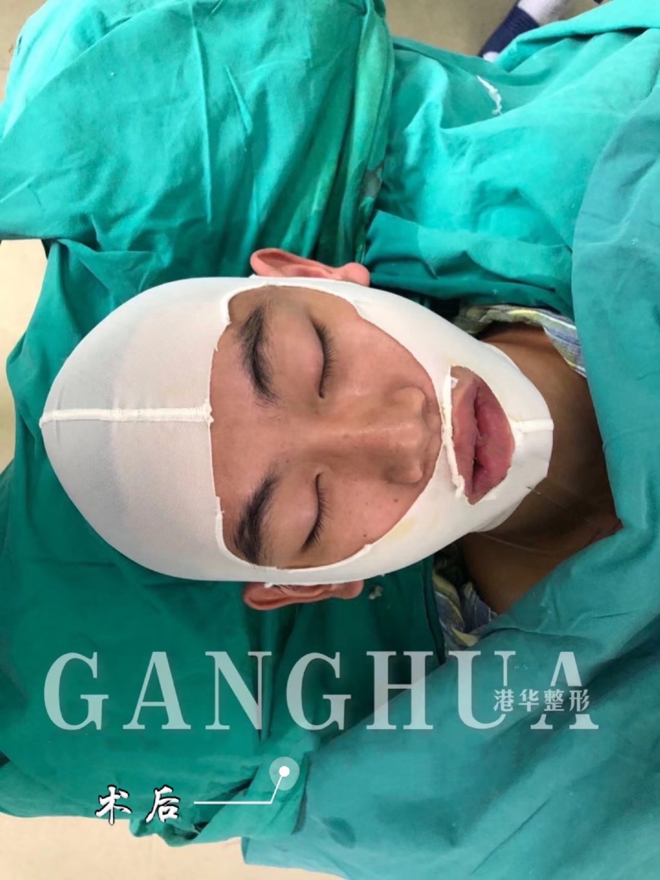 男士颧骨内推术后即刻对比