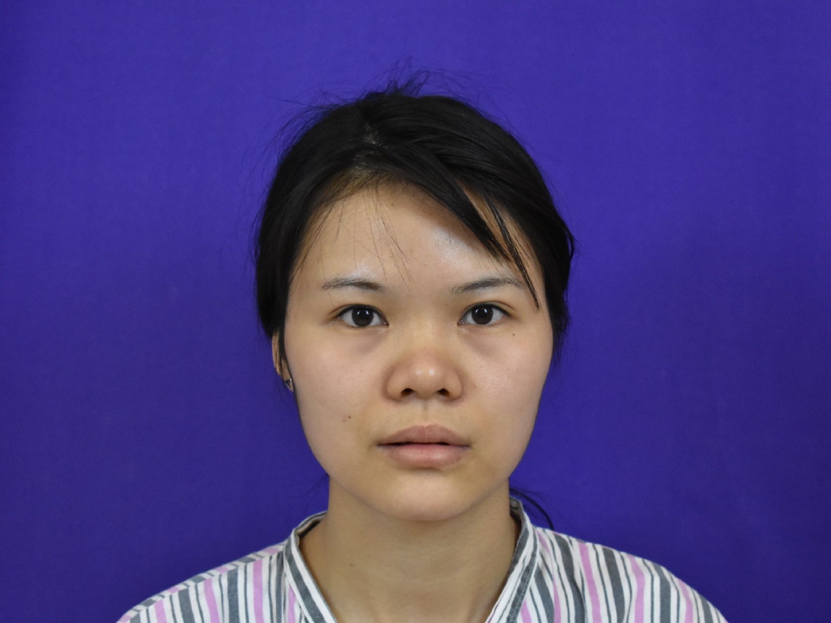 面部较平,鼻头圆润没有山根,鼻基底凹陷侧脸也特平