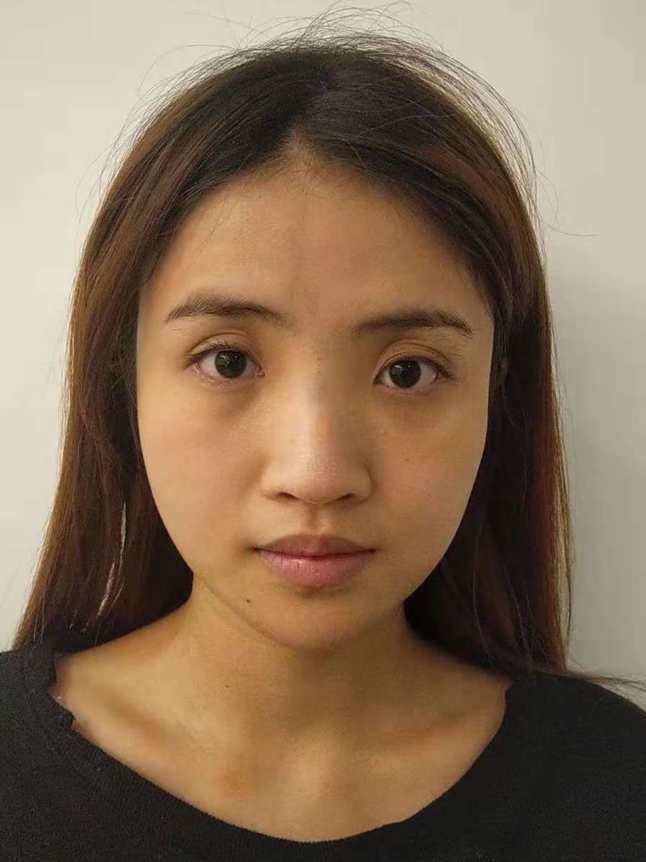 姑娘没有山根,鼻头扁平,鼻基底凹陷