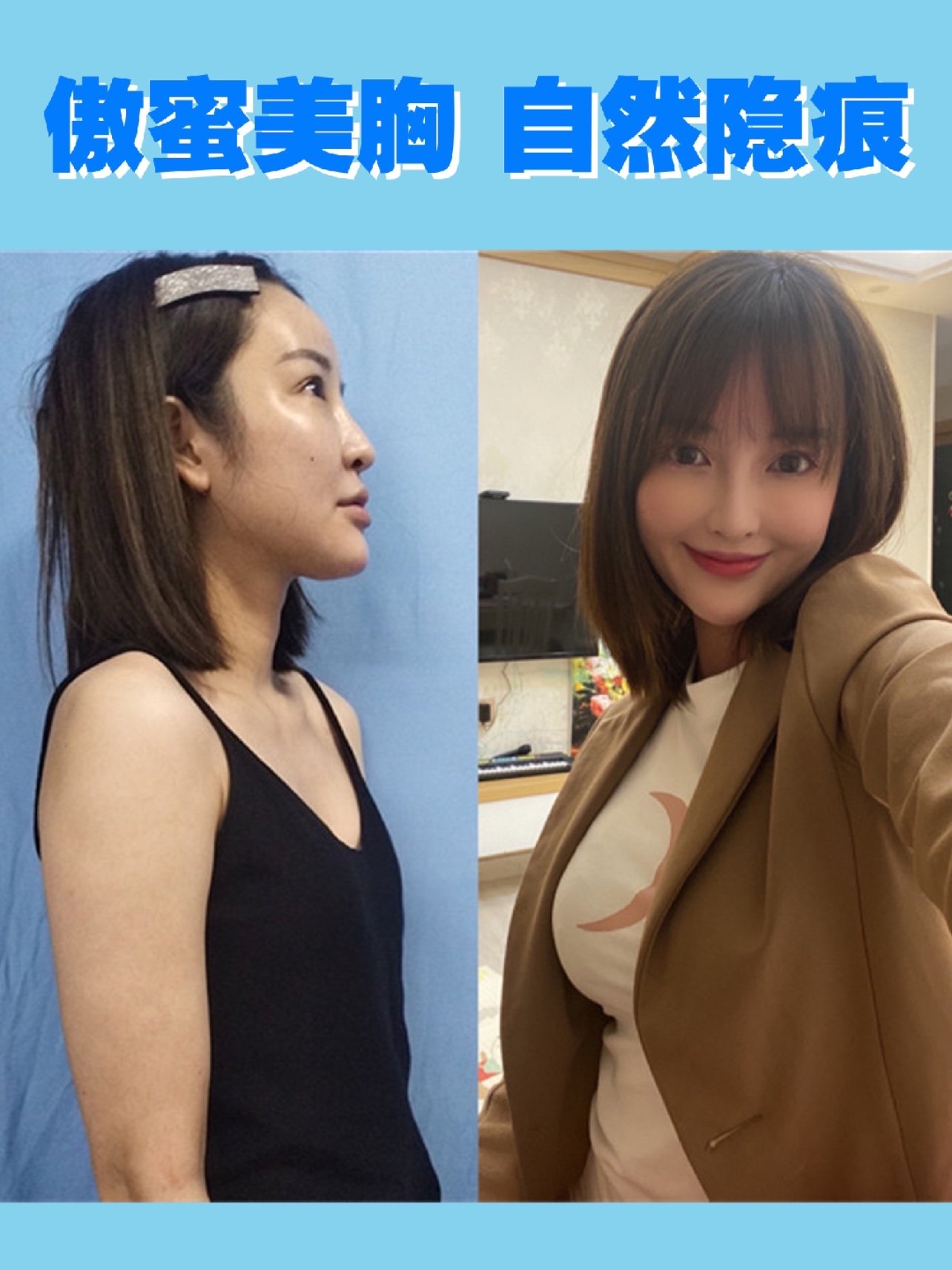 【术前诊断】:求美者术前双侧乳房扁平,乳晕较大,因_圈子-新氧美容