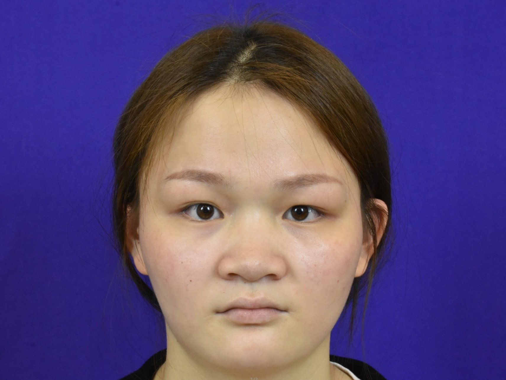 顾客几乎没有山根鼻翼宽大鼻尖没型