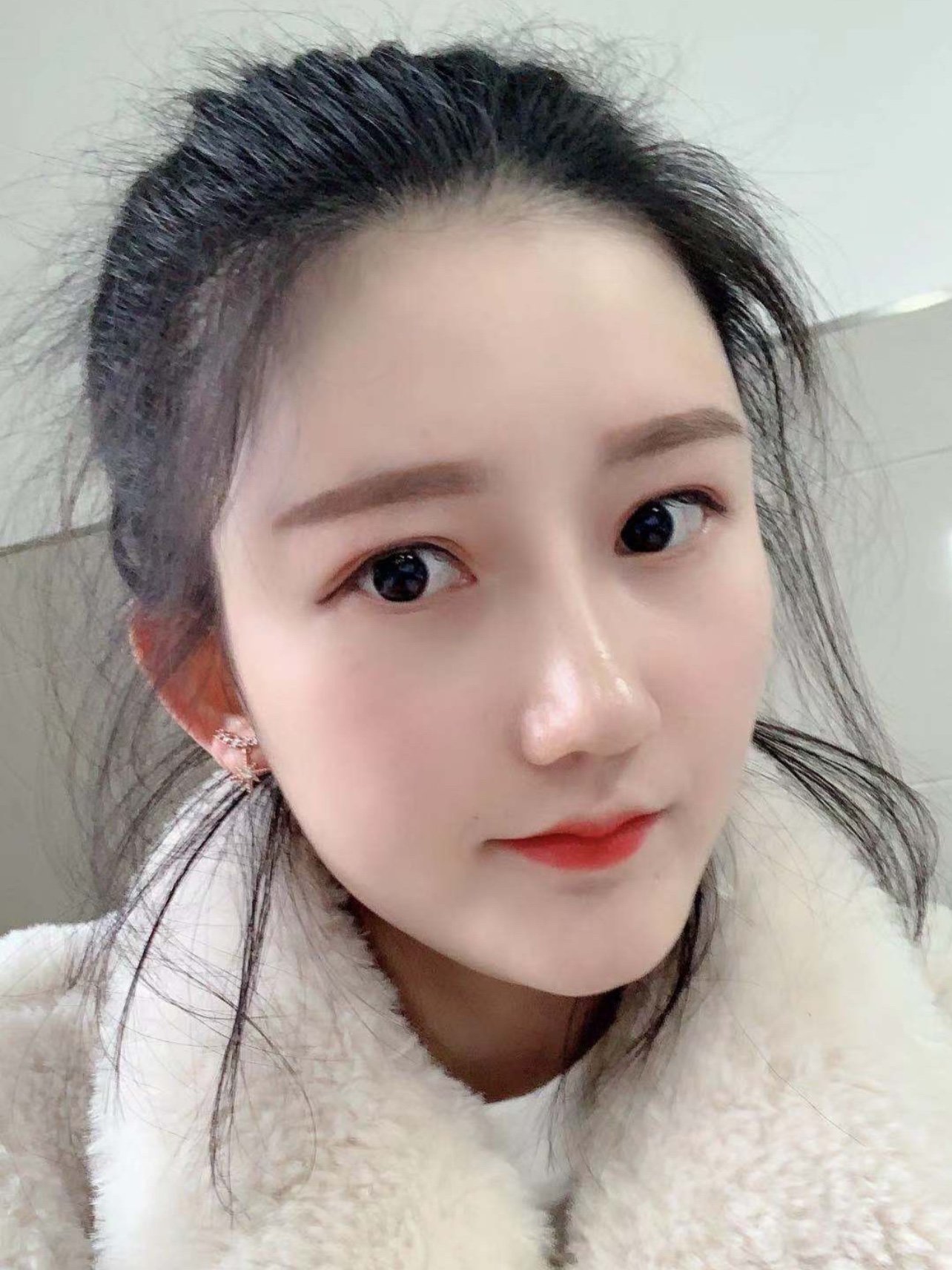 肋软骨隆鼻自然得像妈生一样