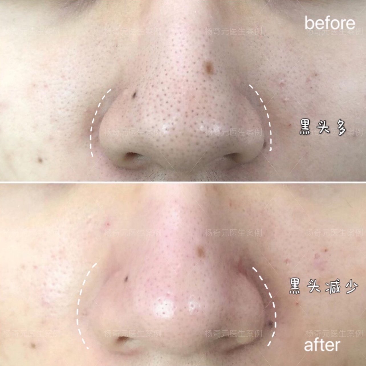 【杨奇元医生-黄金微针祛黑头缩毛孔案例】鼻部黑头较_圈子-新氧美容