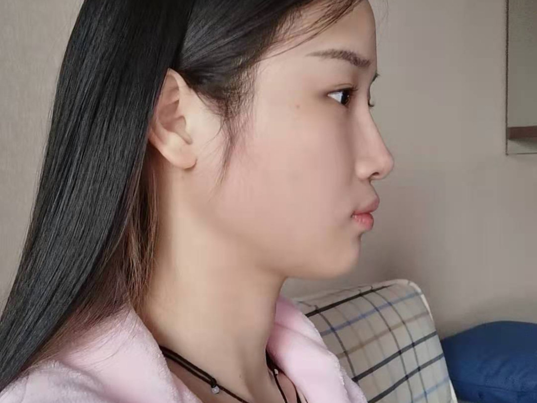 我的下颌角特别厚,本来脸型就比较短,看着又短又宽,_圈子-新氧美容