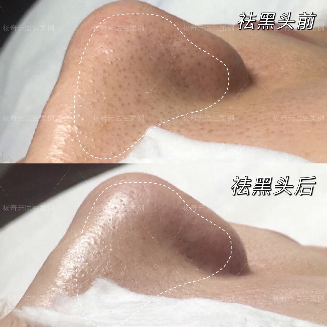 杨奇元医生超微小气泡清洁祛黑头案例