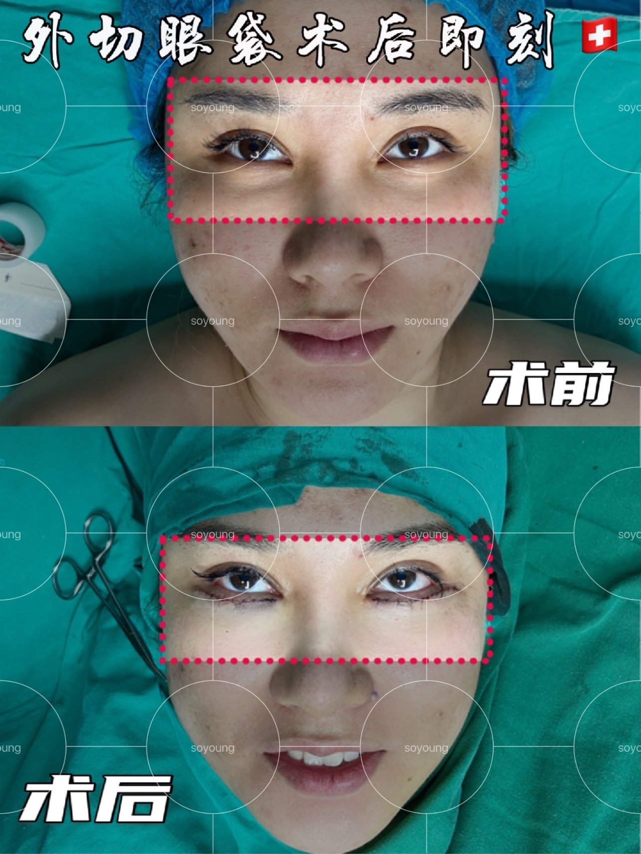 外切去除眼袋眶隔释放术后即刻