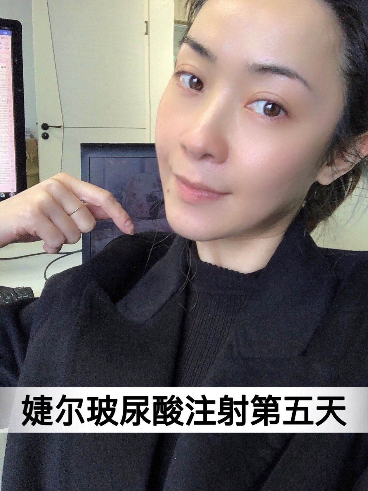 捷尔玻尿酸注射法令纹第766天