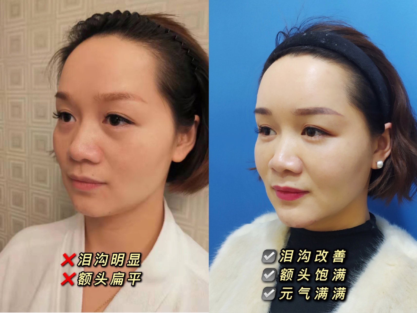 自体脂肪全脸精细化填充,如何又美又自然?