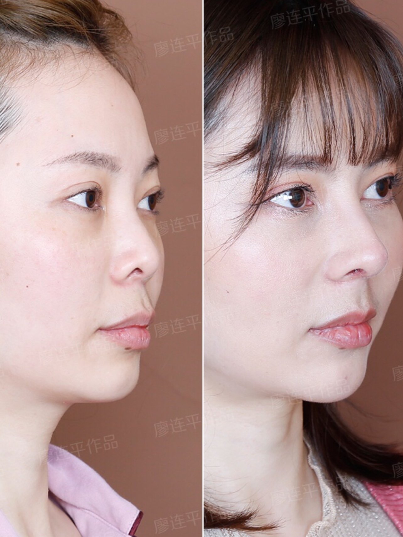 鼻子鼻基底综合改善减龄又漂亮