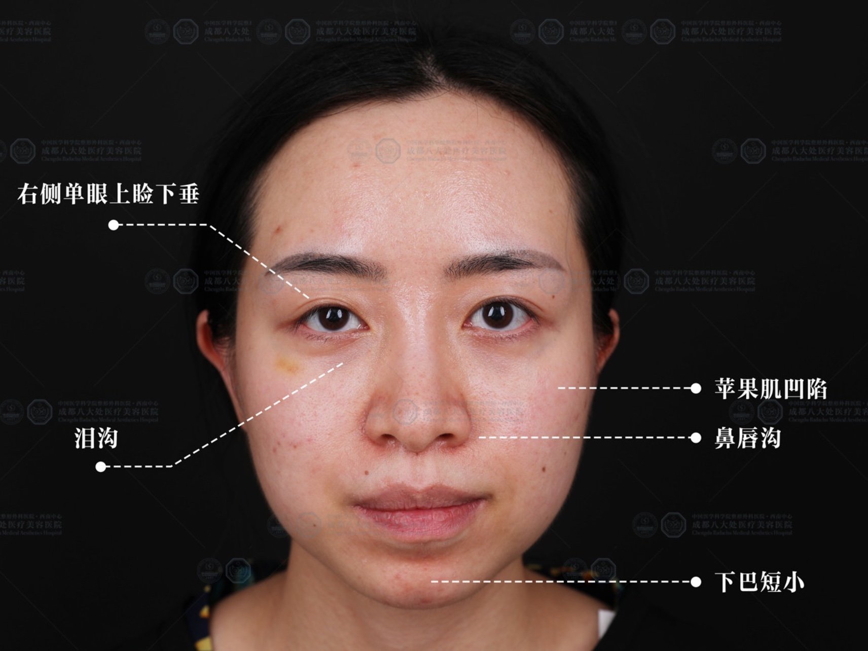 案例赏析 术前评估:右侧单眼上睑下垂,泪沟,苹果肌凹陷,鼻唇沟,下巴