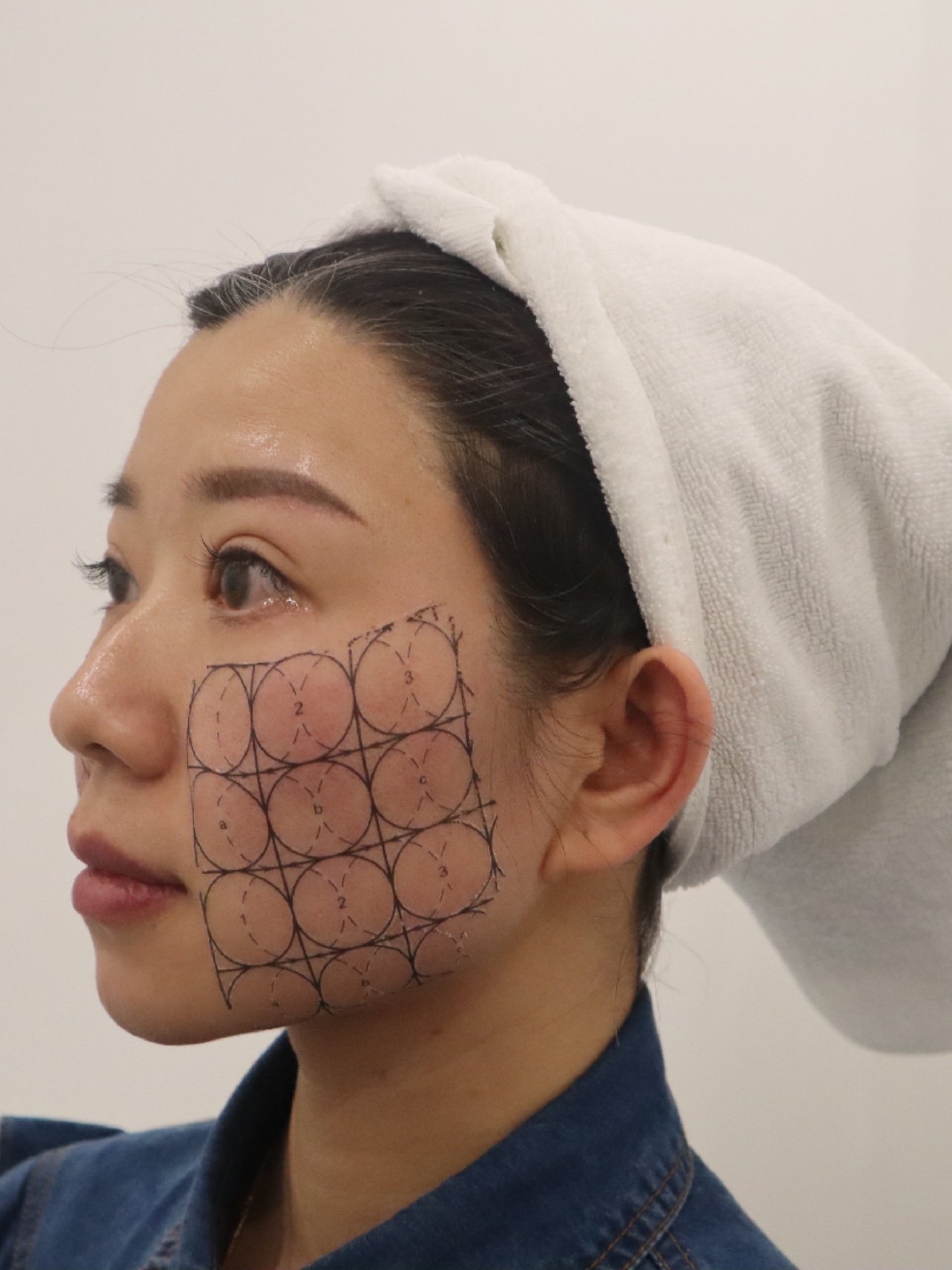 热拉提plus术后一个月原相机对比图来啦!过完年长_圈子-新氧美容整形